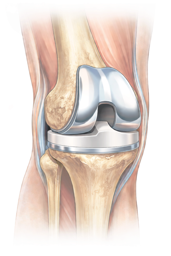 Medical illustration of knee replacement implant used to restore joint function.