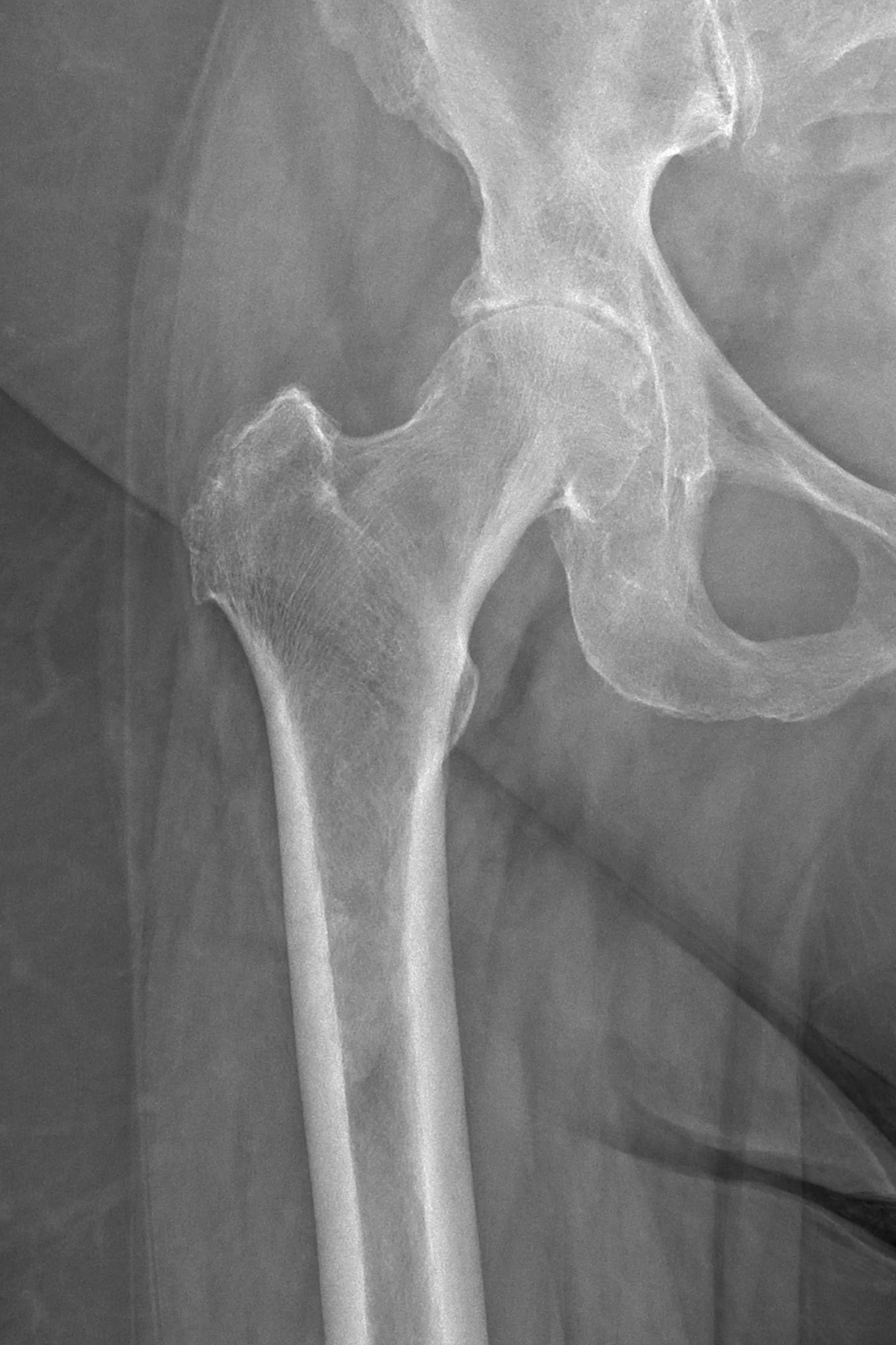 X-ray of hip joint with advanced arthritis prior to hip replacement surgery.