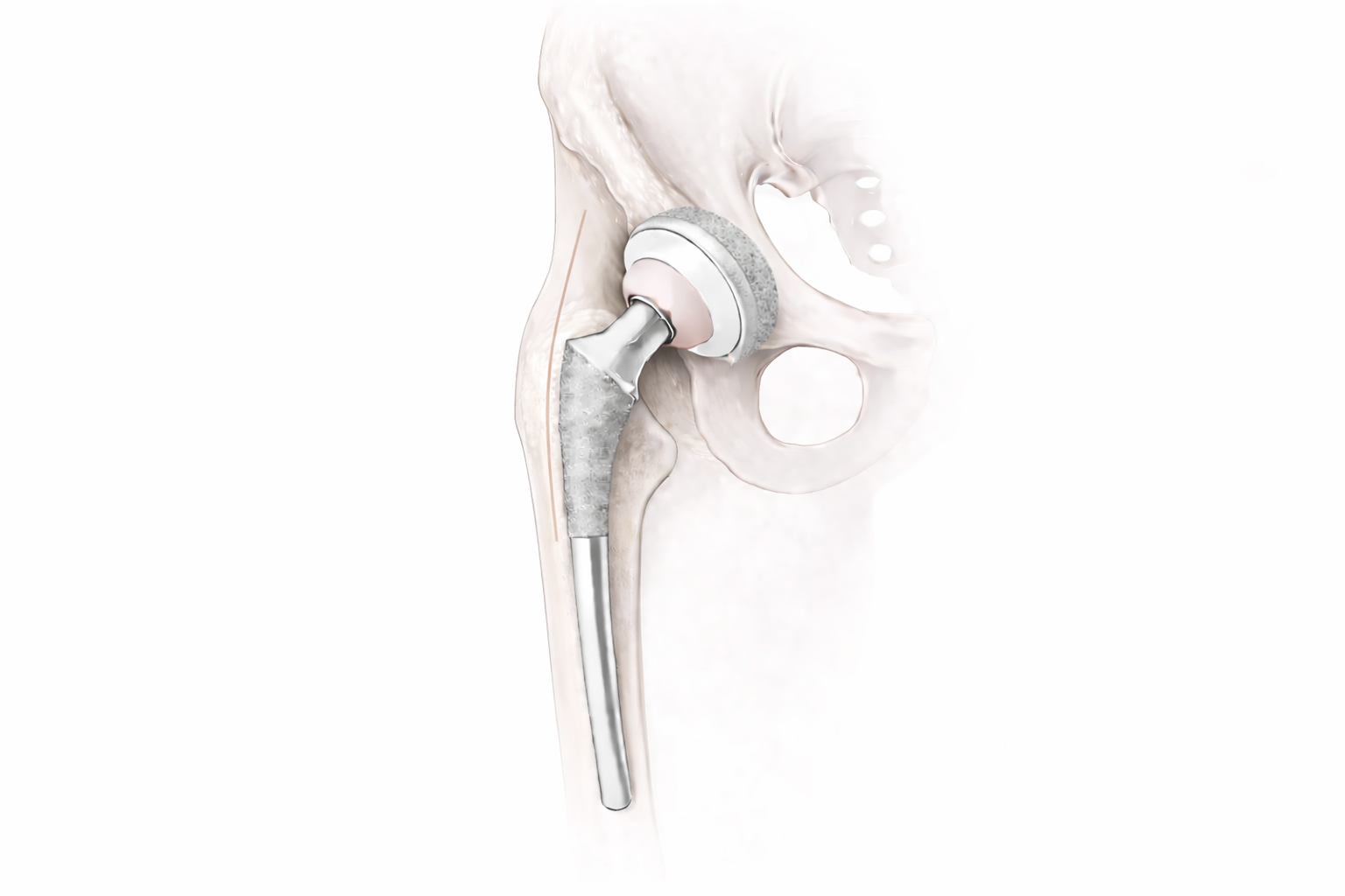 Medical illustration of anterior hip replacement showing implant positioning in the pelvis and femur.