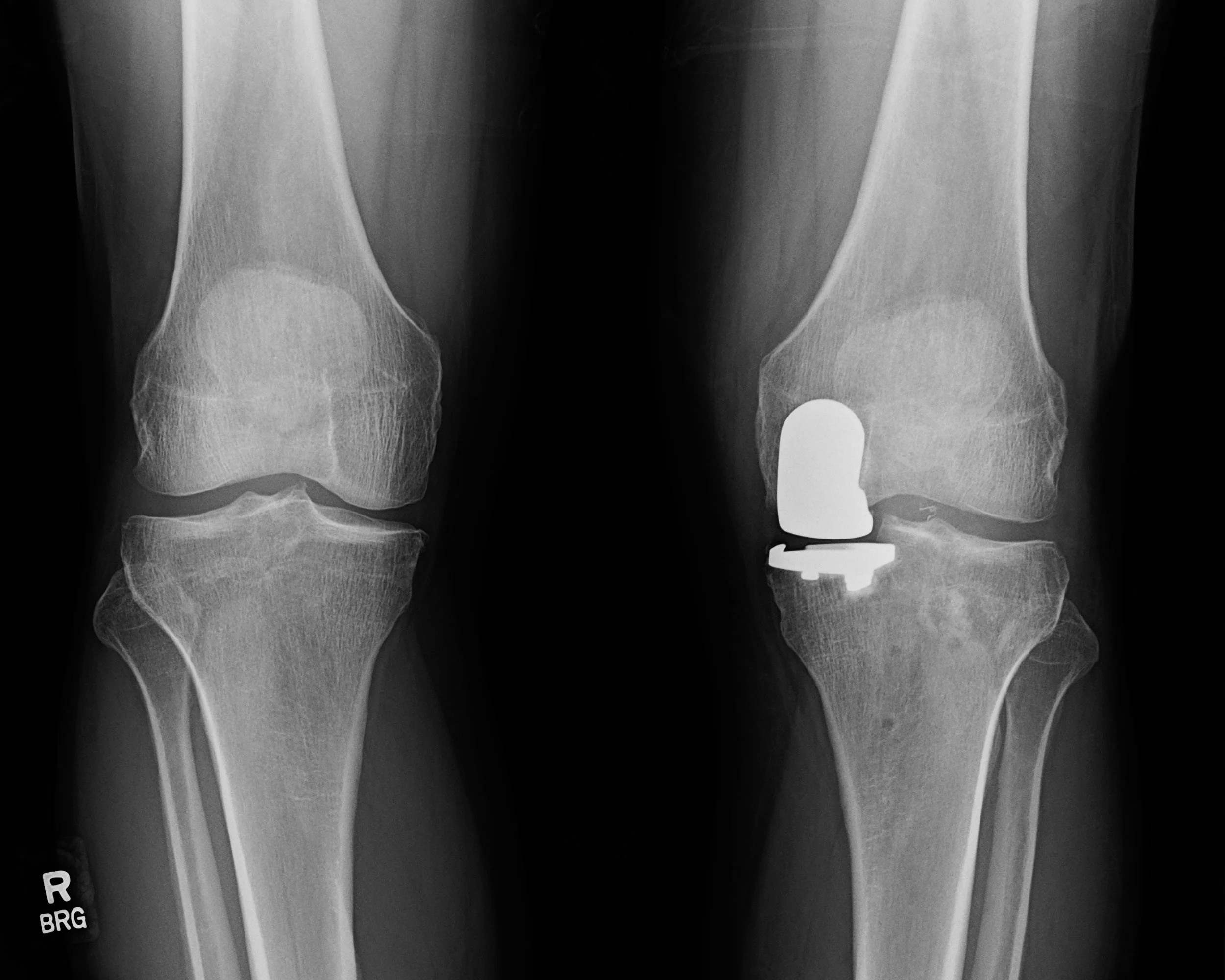Partial knee replacement implant preserving natural knee structures for isolated arthritis.