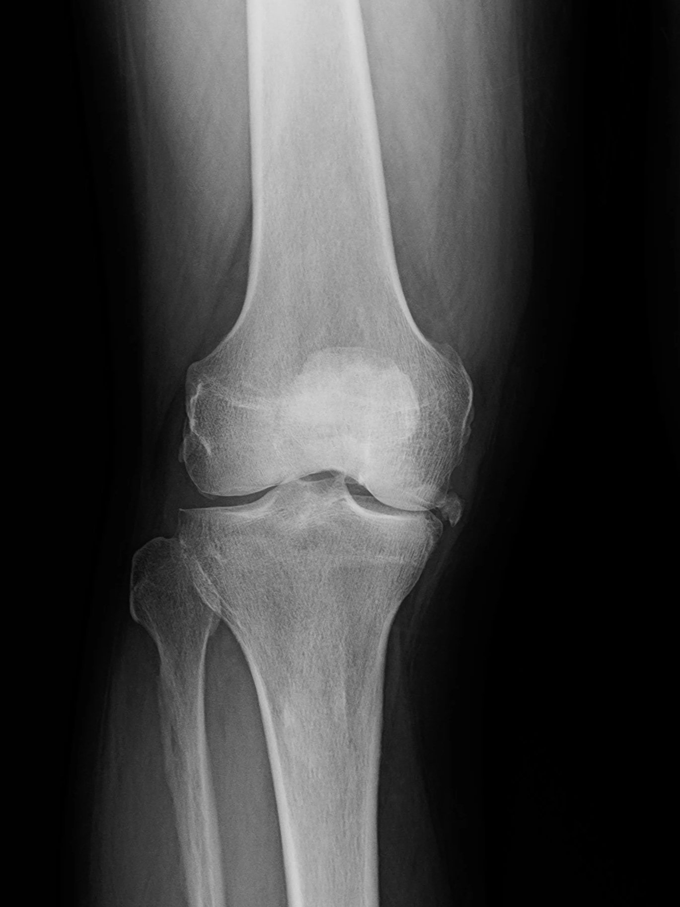 X-ray of knee showing joint space narrowing from osteoarthritis.