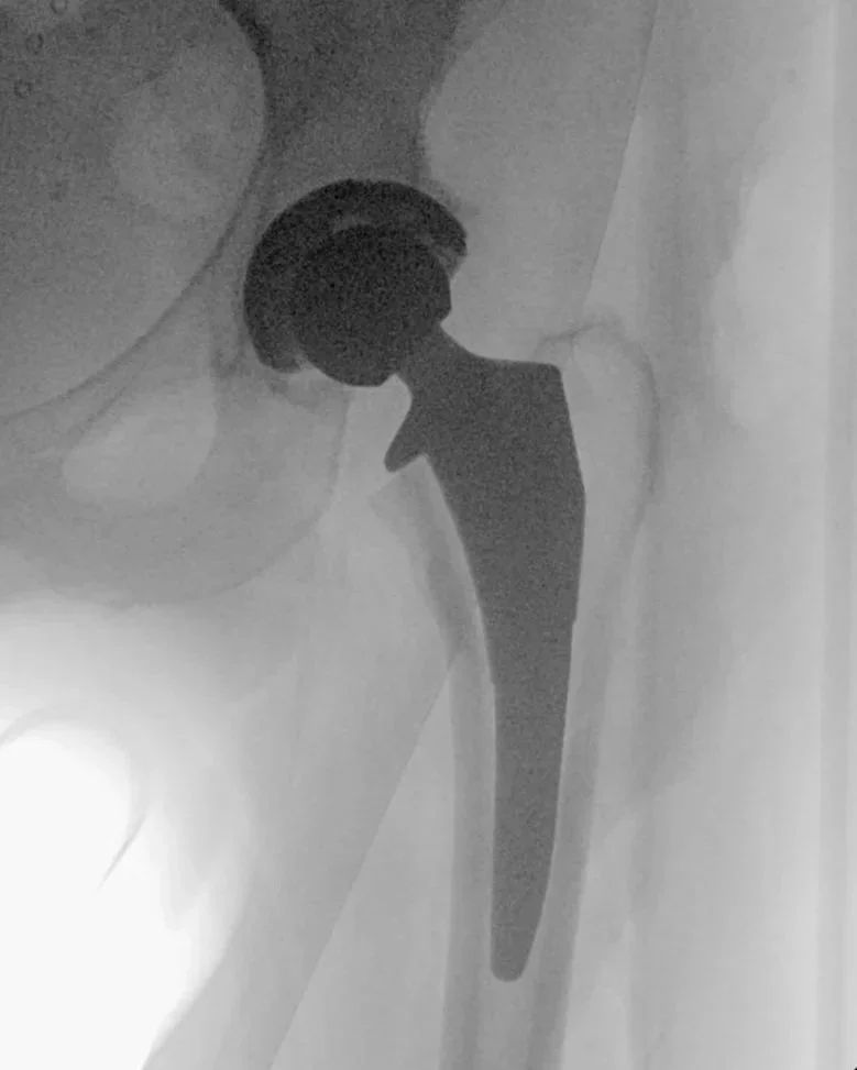 Hip replacement prosthesis demonstrating joint reconstruction for arthritis pain relief.