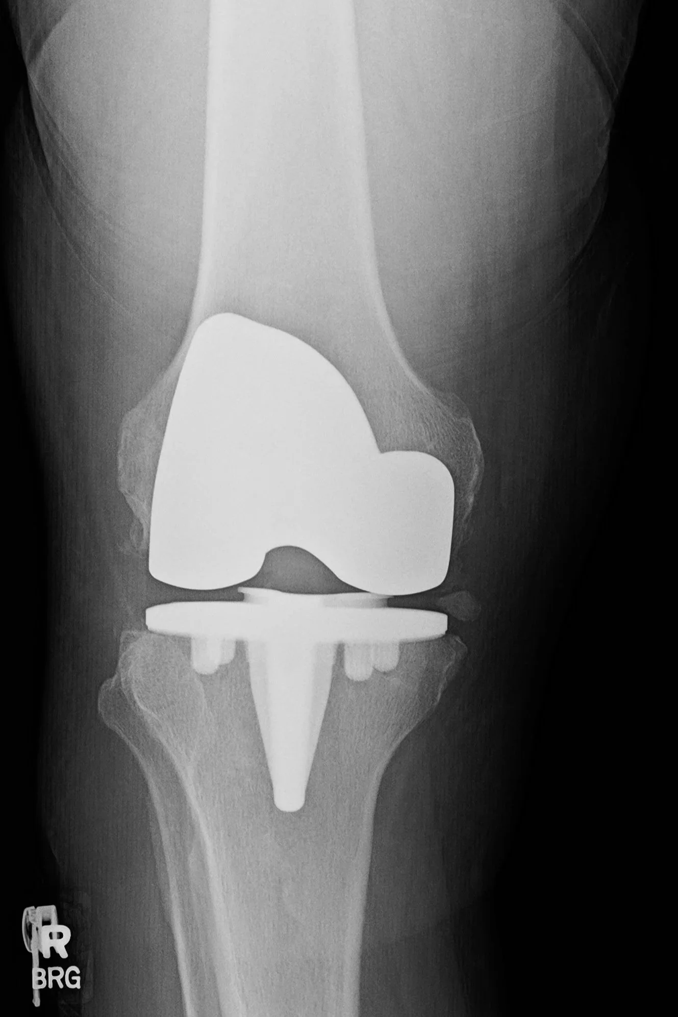 X-ray showing total knee replacement with prosthetic components in place.