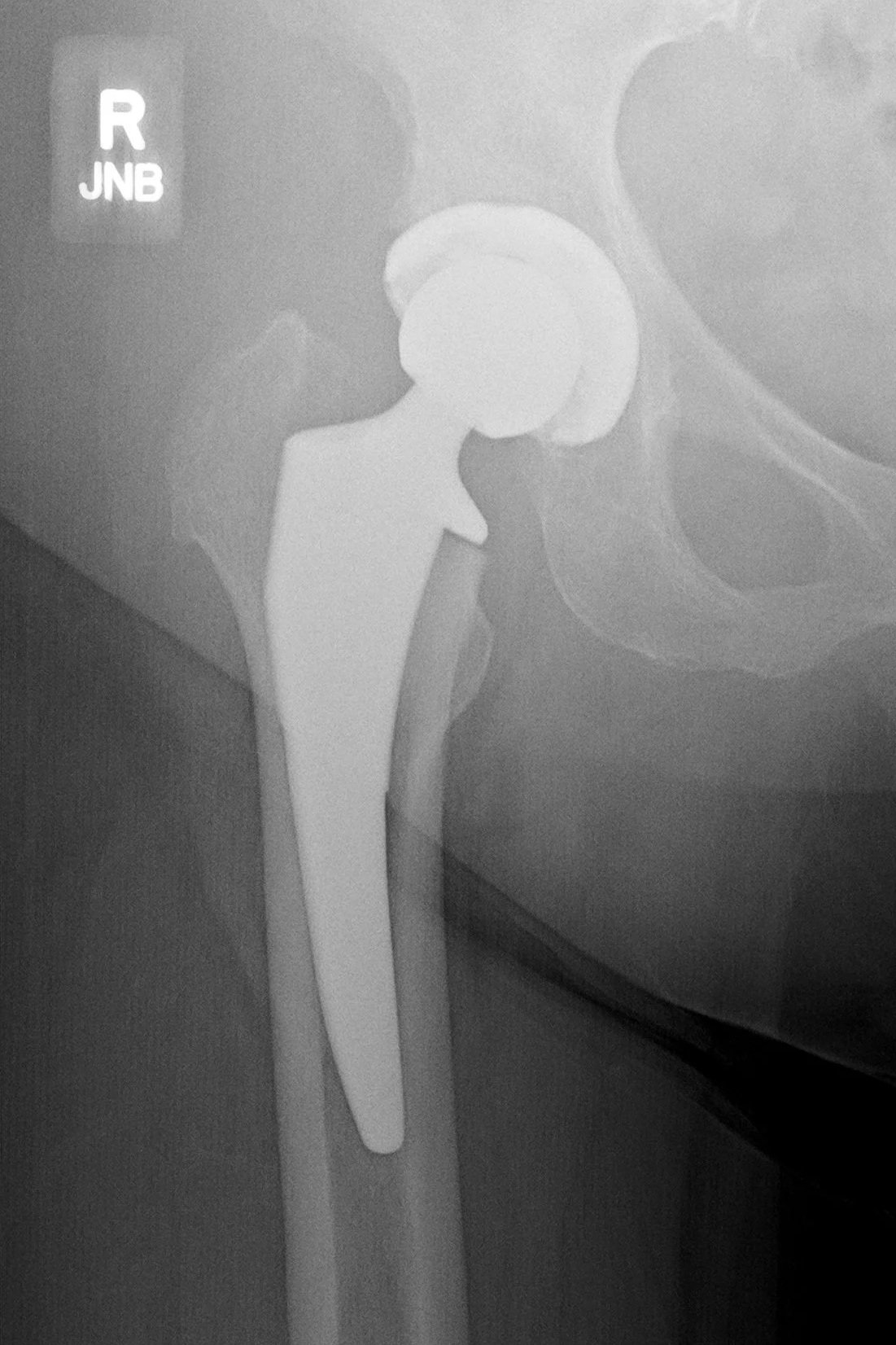 X-ray showing total hip replacement implant after anterior hip surgery.