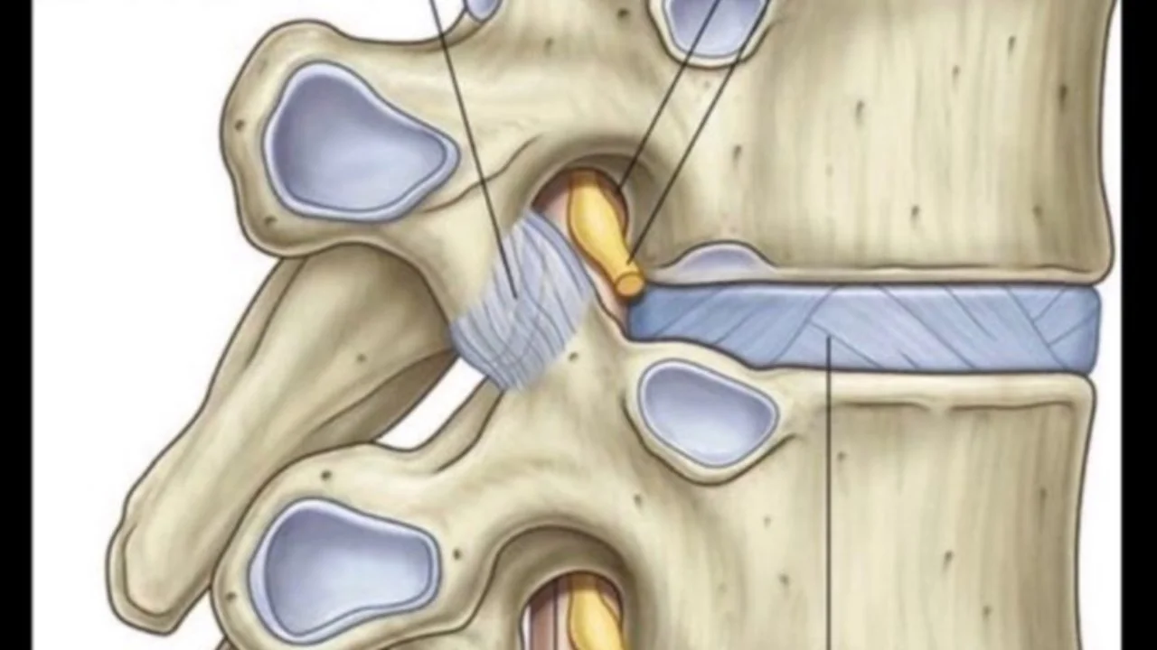 What to Do With a “Slipped Disc”