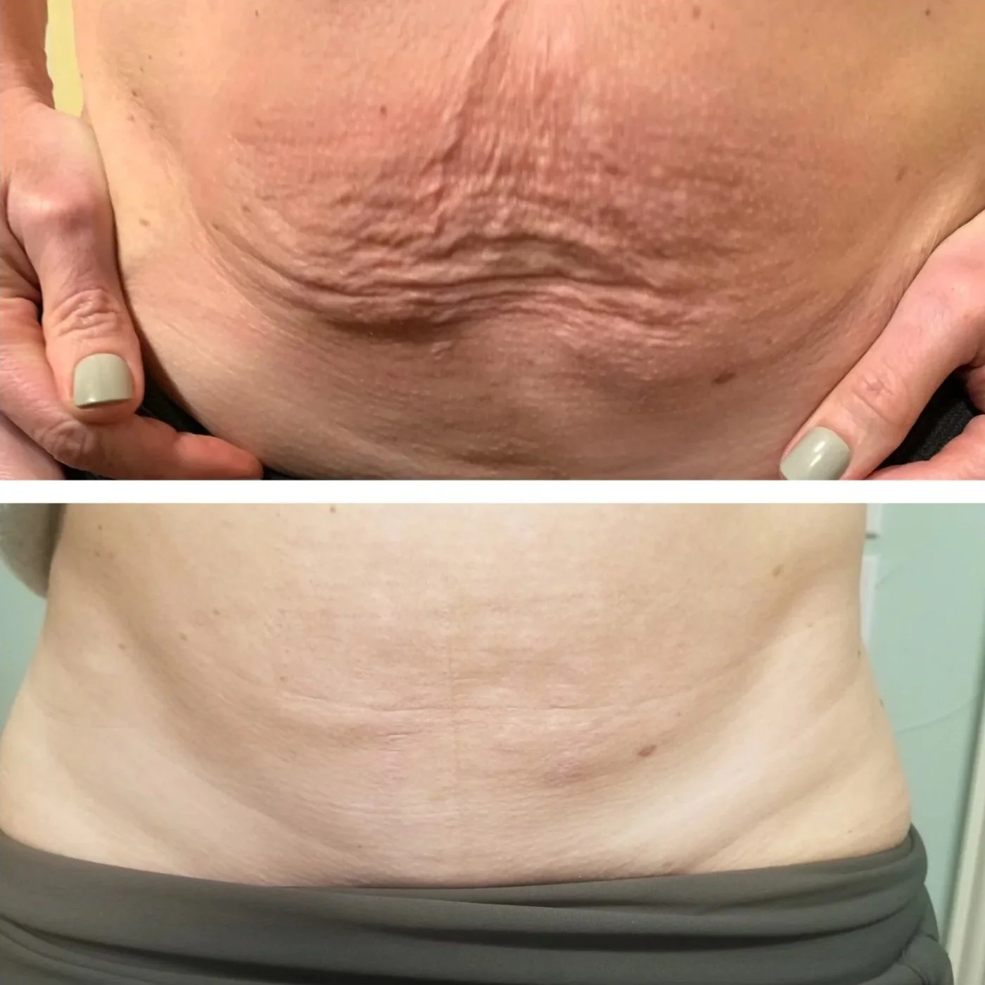 Comparison of a wrinkled, sagging abdomen at the top and a smoother, tighter abdomen at the bottom.