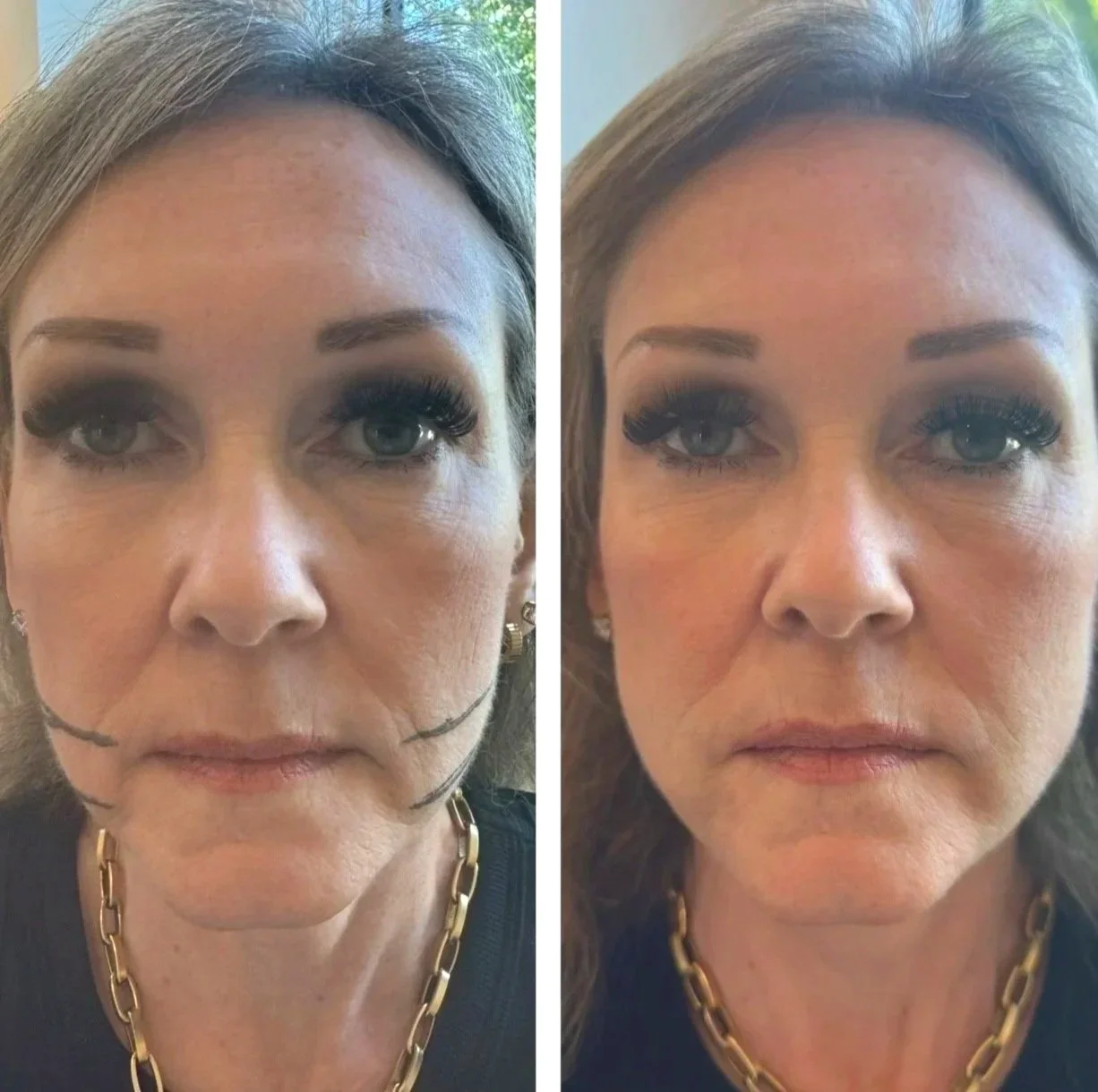 Side-by-side comparison of a woman before and after cosmetic procedures. Both images show her facing forward with makeup, gold chain necklace, and earrings, but the image on the left has black markings around her mouth and chin indicating planned areas for treatment.