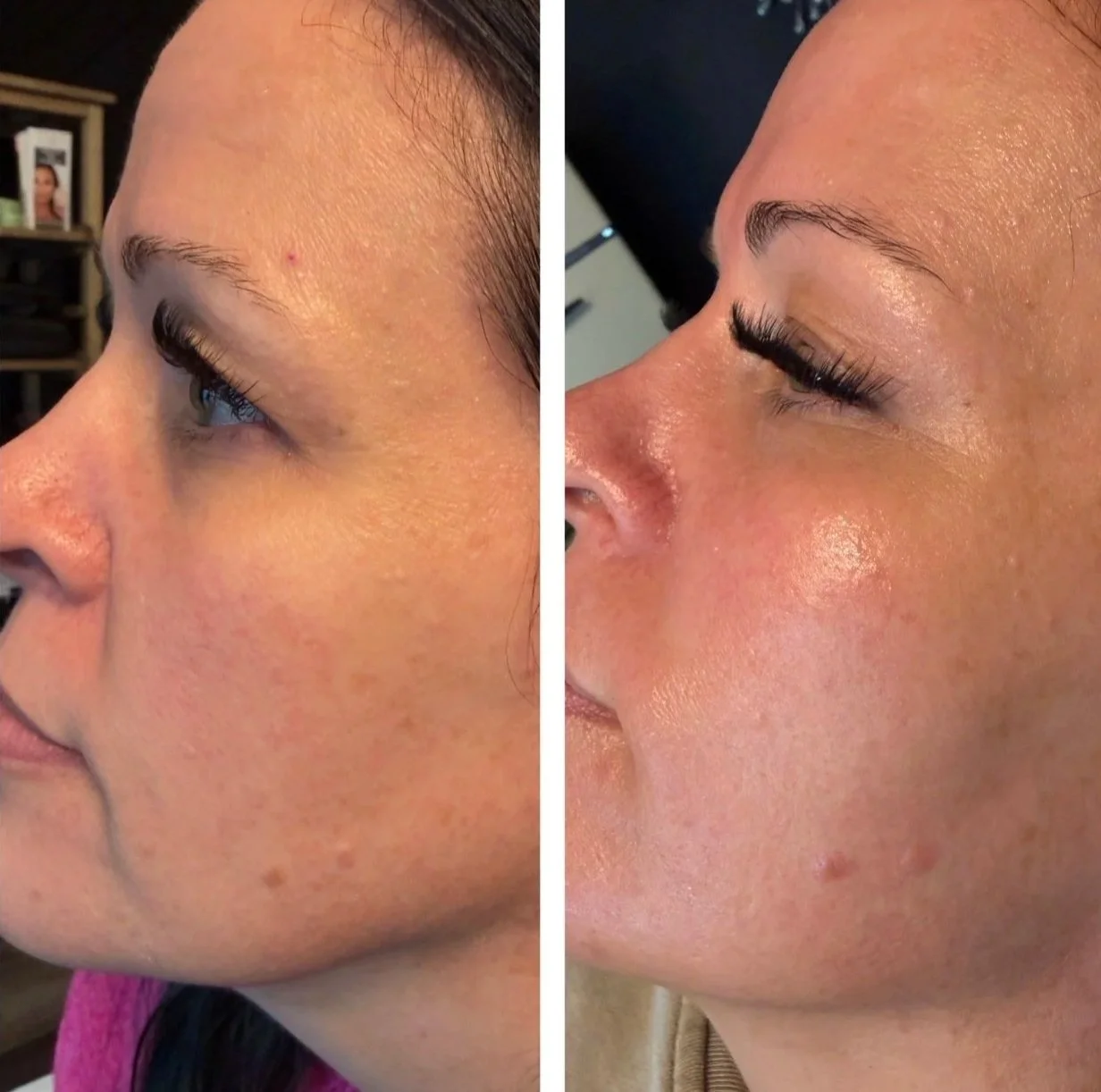 Side-by-side comparison of a woman's face, showing before and after skin treatment. The 'before' side shows uneven skin texture with visible pores and pigmentation. The 'after' side exhibits smoother, clearer skin with a more even tone and reduced pores.