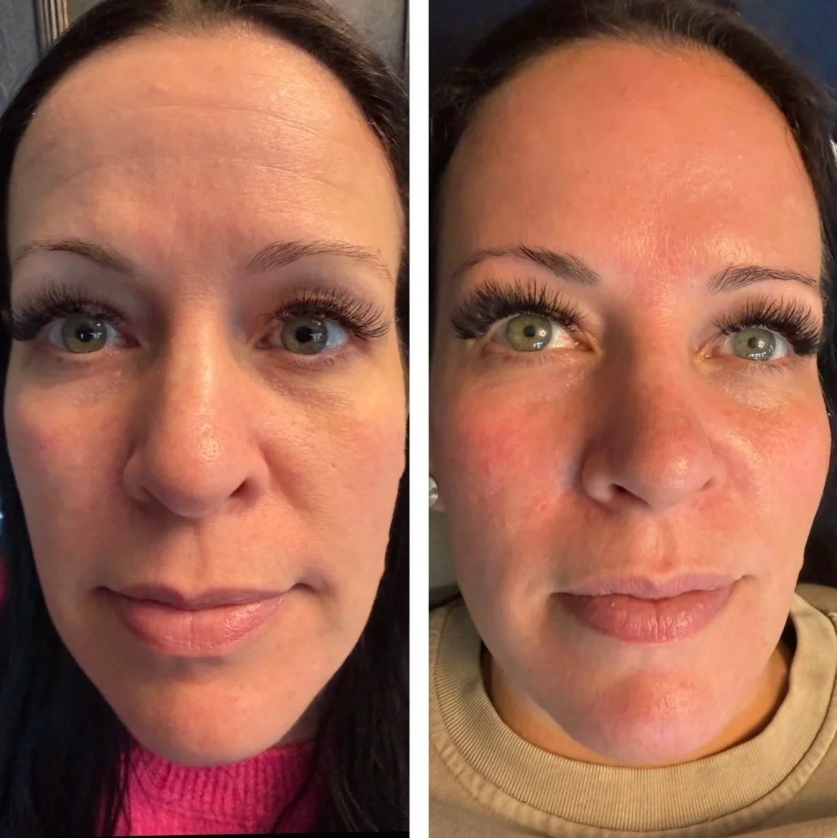 Side-by-side comparison of a woman's face before and after a skin treatment, showing a reduction in redness and skin smoothness.