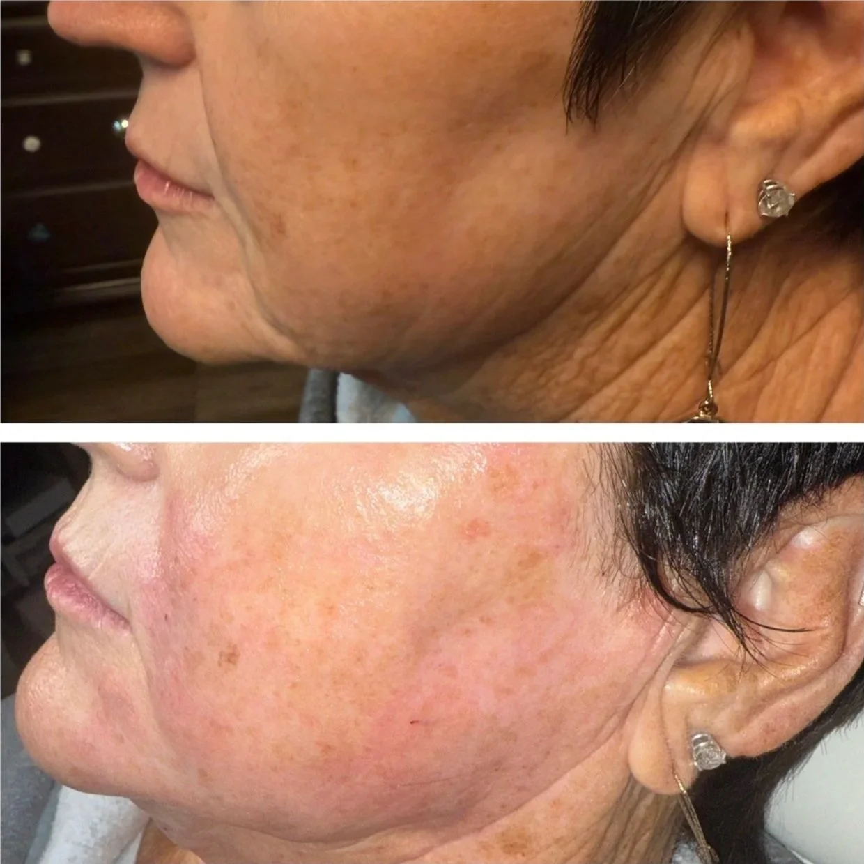 Comparison of a person's facial skin before and after a skincare treatment showing reduced pigmentation, redness, and improved skin texture.