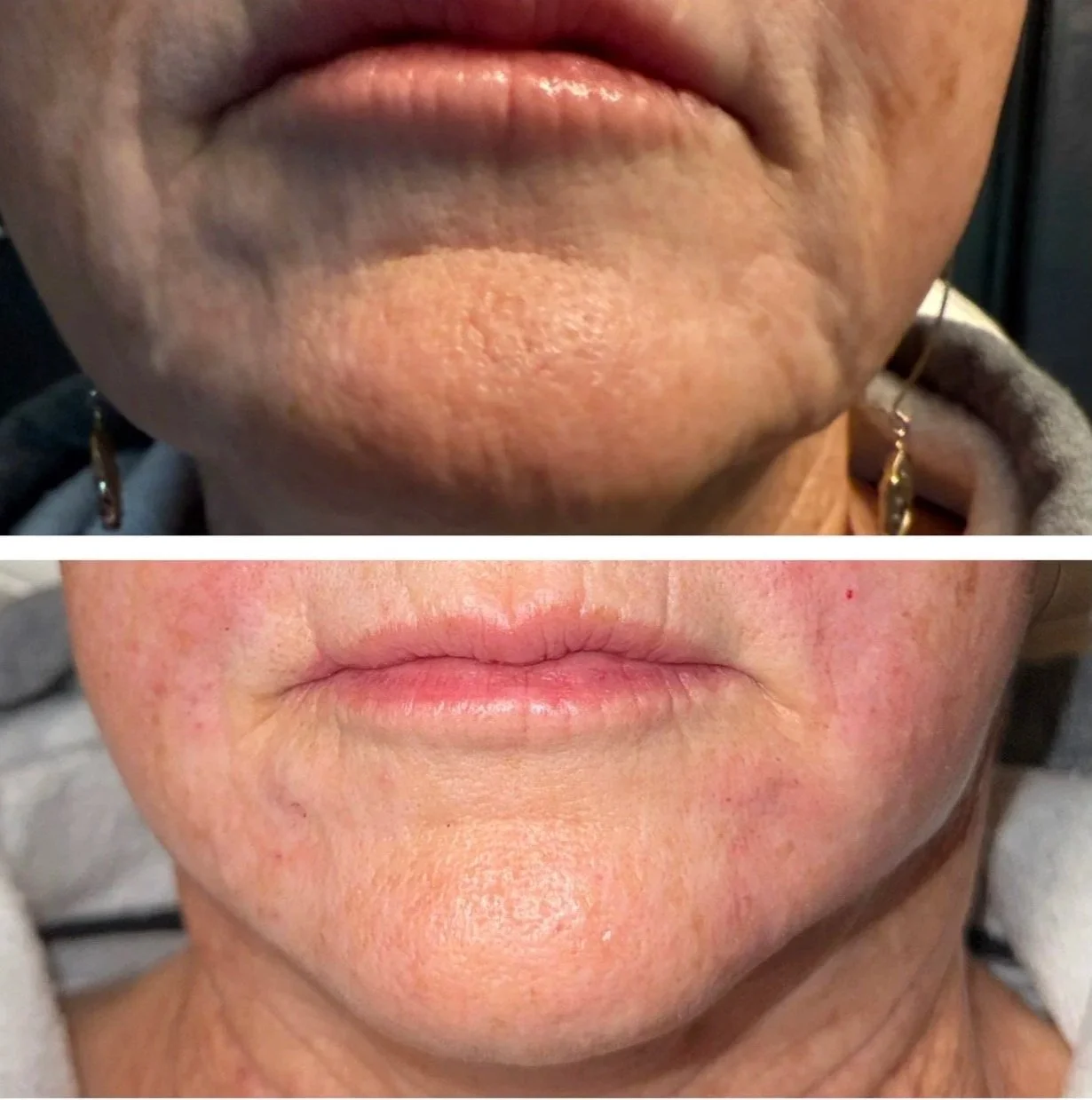 Comparison of a person's lips and surrounding facial skin before and after improvement. The top image shows dry, wrinkled lips with uneven skin, while the bottom image shows smoother, more hydrated lips and improved skin texture.
