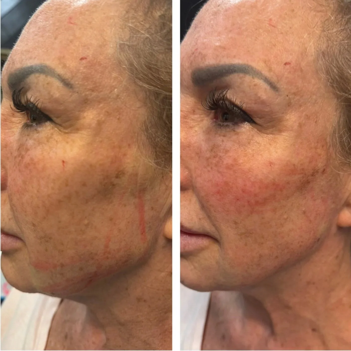 Side-by-side comparison of a woman's face before and after skin treatment, showing reduced age spots and improved skin texture.