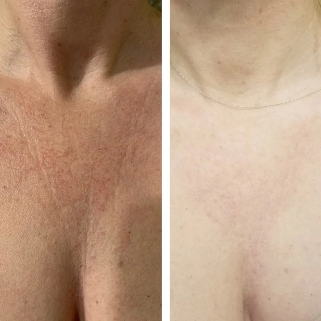 Close-up of skin before and after treatment, showing reduction in redness and blemishes.