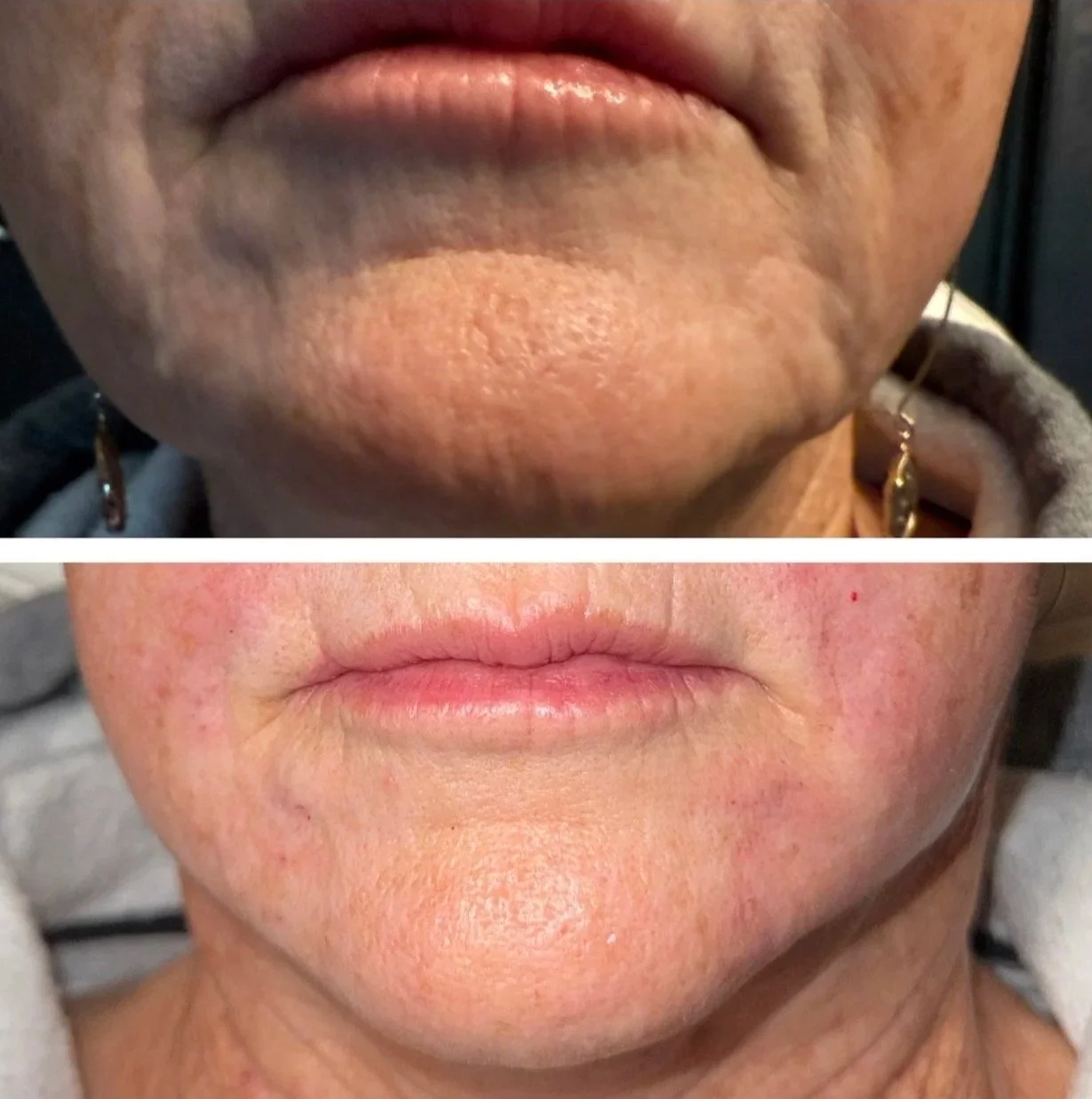 Comparison of a person's lips and surrounding skin before and after treatment, showing smoother skin and more defined lips in the after image.