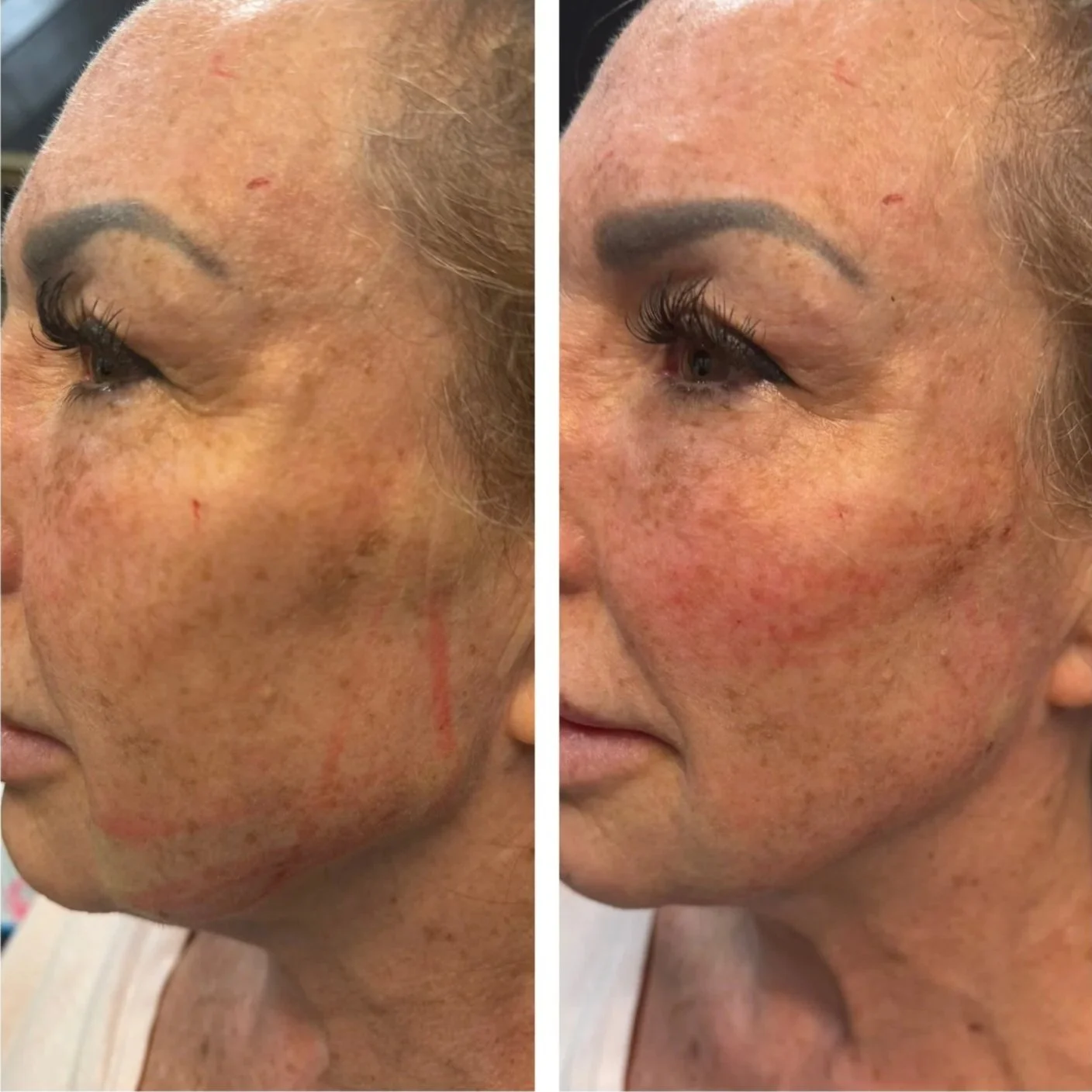 Side-by-side comparison of a woman’s face showing improvement in skin clarity and reduction of dark spots and pigmentation.