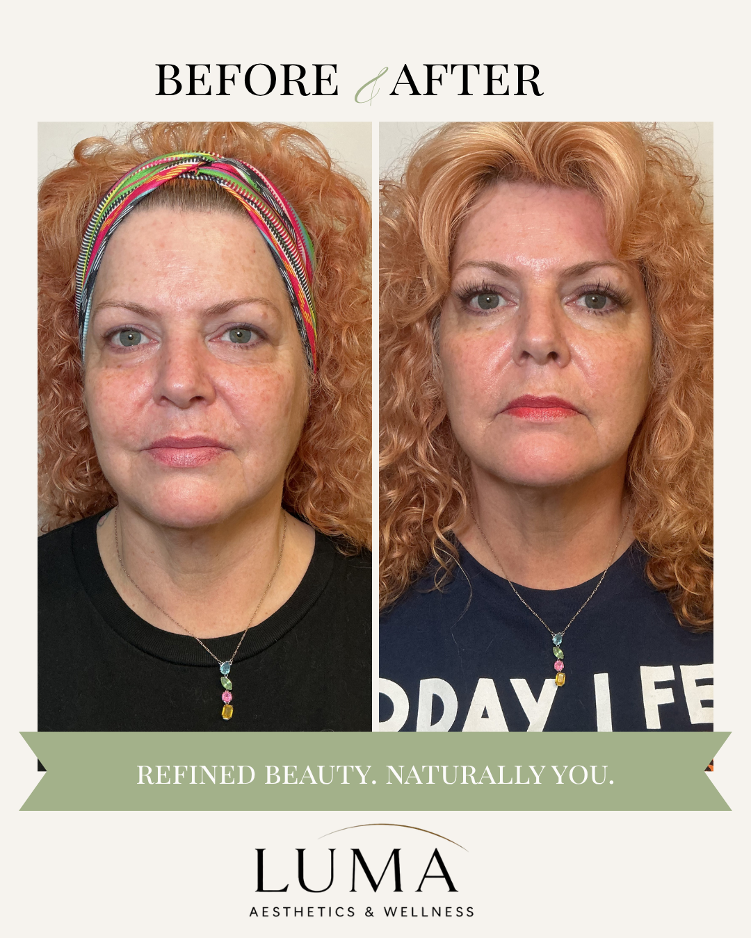Side-by-side before and after photos of a woman with curly red hair, showing improvements in skin appearance, promoting natural beauty and wellness.
