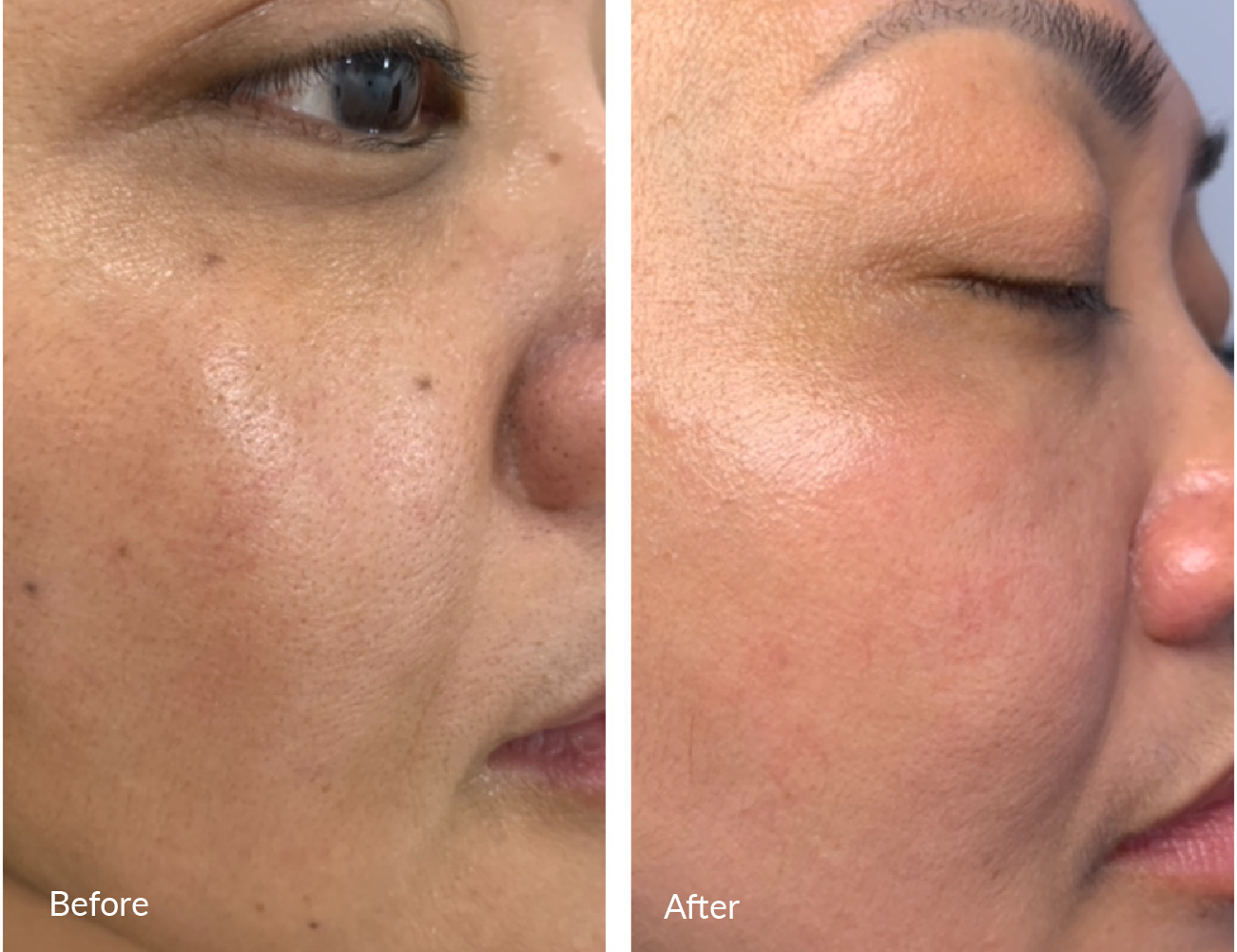 Close-up side-by-side comparison of a person's face labeled as before and after, showing improved skin condition after skincare treatment.