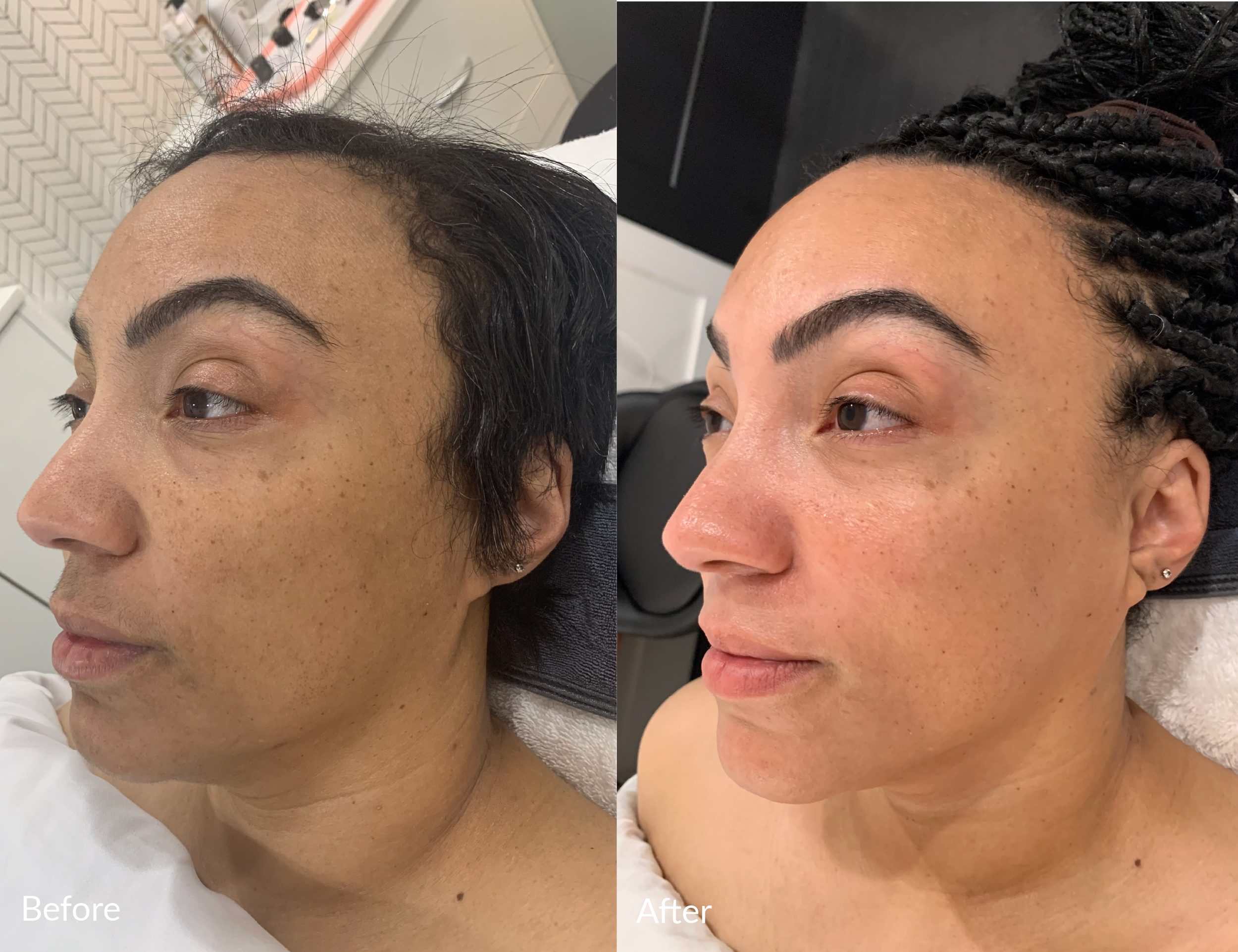 Side-by-side comparison of a woman's face showing the 'before' and 'after' results of a skincare or cosmetic treatment, with smoother skin and reduced blemishes in the after photo. She has dark hair, some of it braided in the after photo.