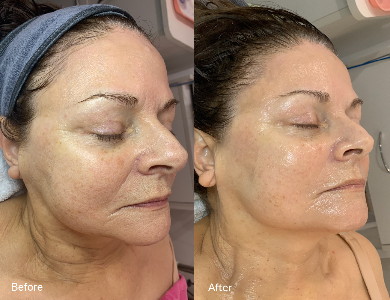 Side-by-side comparison of a woman's face before and after skincare or cosmetic treatment. The left side shows her with visible skin imperfections, while the right side shows her with smoother, more even-toned skin.