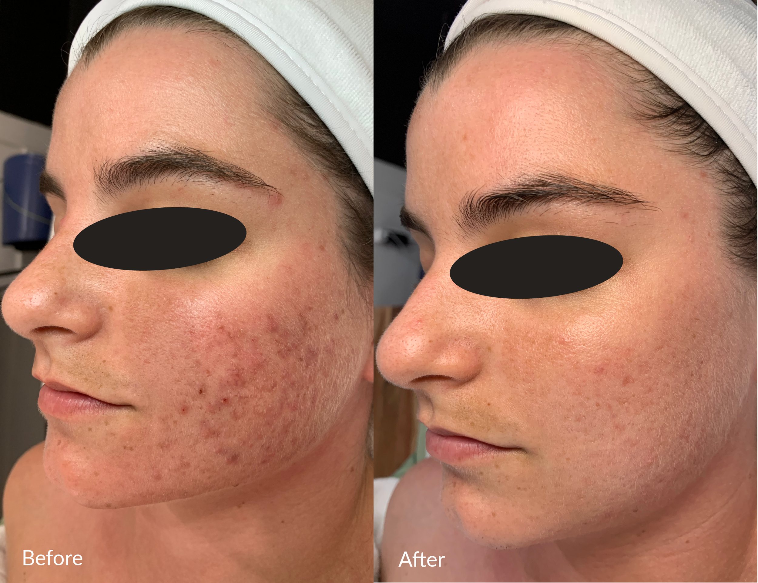 Side-by-side comparison of a woman's face showing the left side before and after skincare treatment. The before image displays visible acne, redness, and uneven skin texture. The after image shows clearer, smoother skin with reduced redness and acne scars.