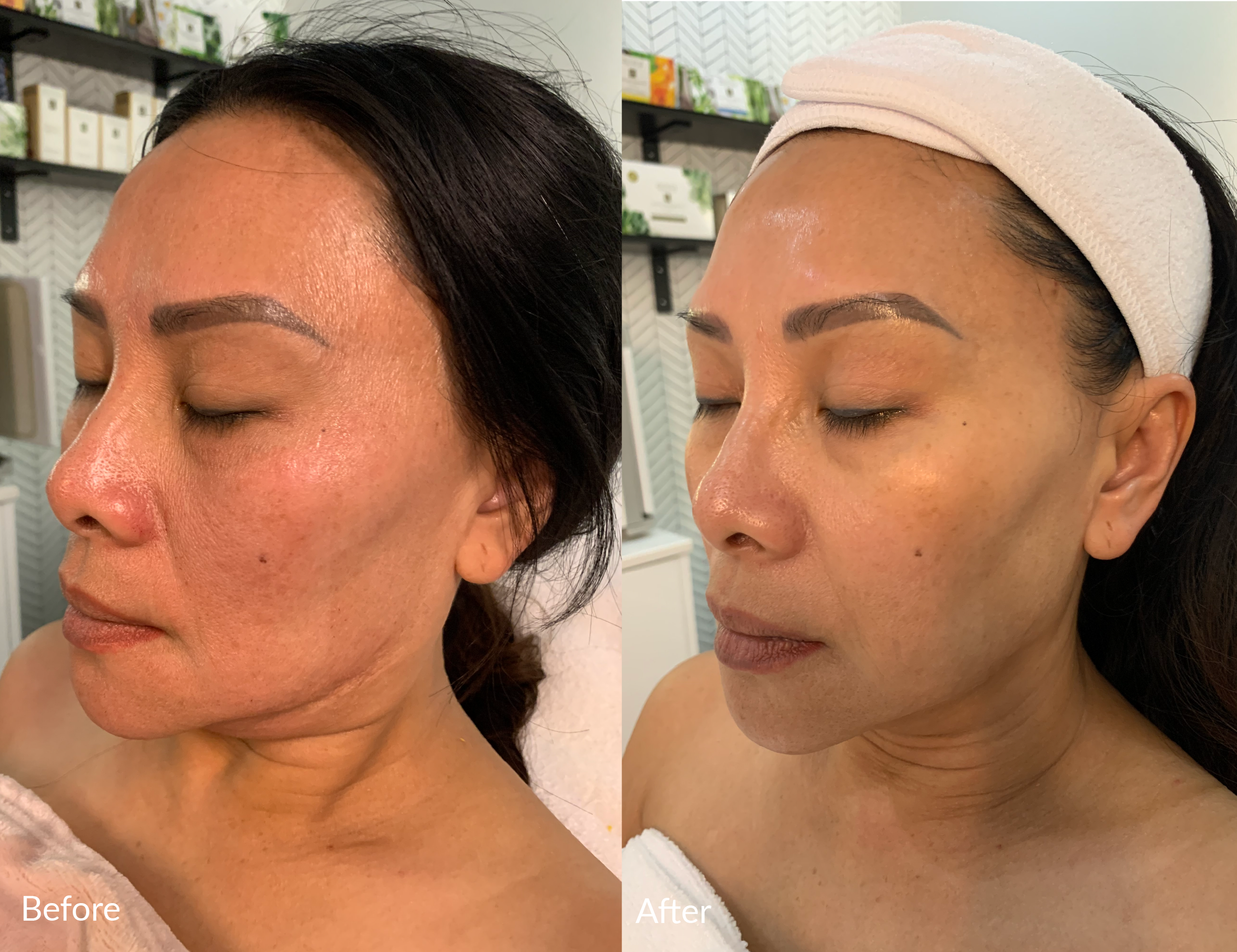 Side-by-side comparison of a woman's face showing before and after likely a skincare treatment, with smoother skin and fewer blemishes in the after image.