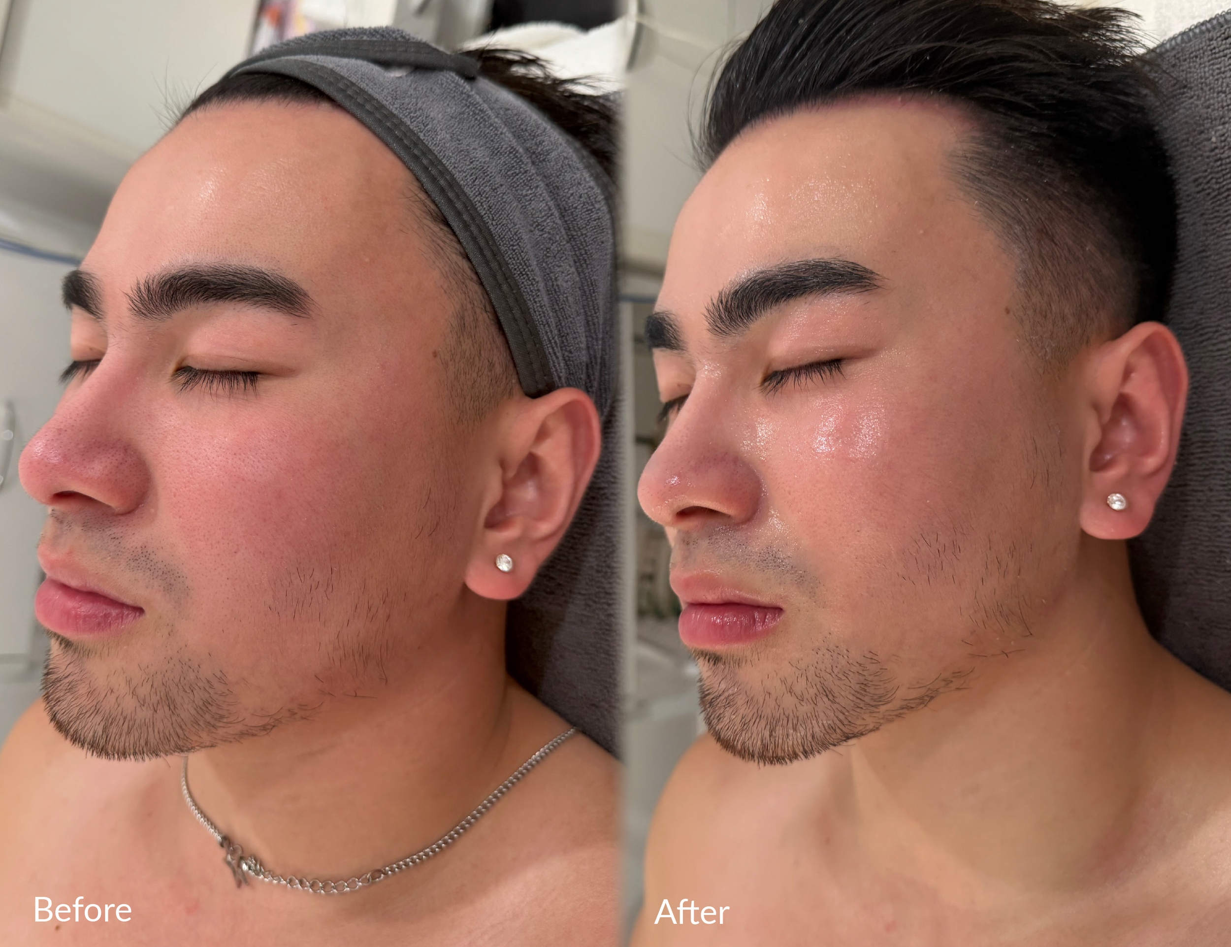 Side-by-side comparison of a man's face before and after a skincare treatment, showing improved skin texture and clarity.