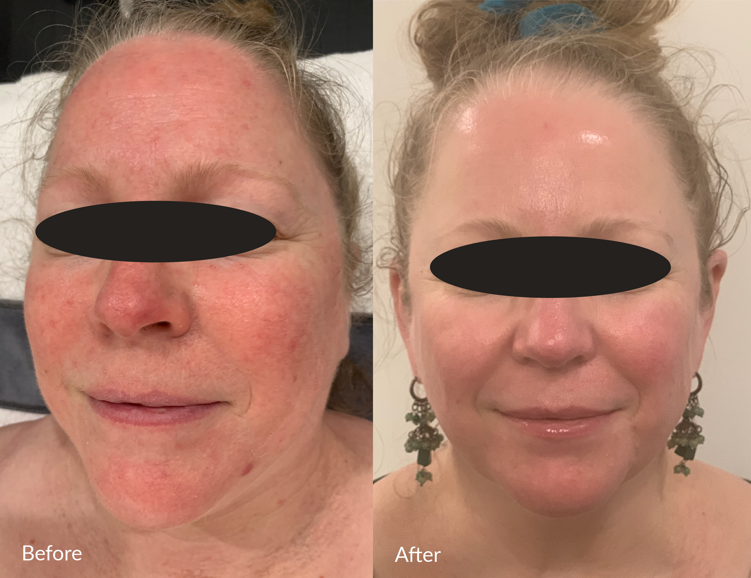 Side-by-side comparison of a woman's face showing skin improvement. The left image labeled 'Before' shows redness, uneven skin tone, and blemishes on her face. The right image labeled 'After' shows clearer, smoother, and more even-toned skin with a glowy appearance.