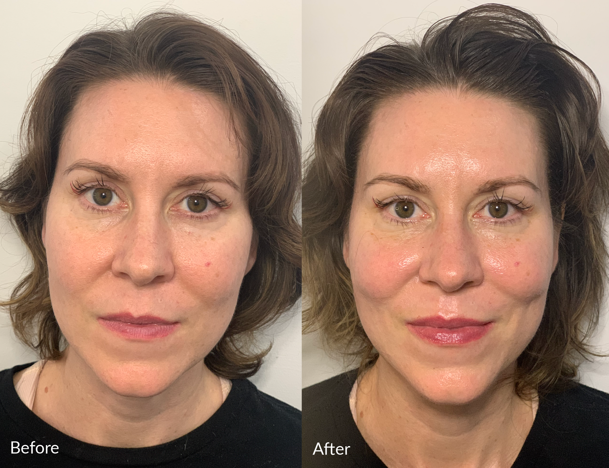 A side-by-side comparison of a woman's face with visible skin improvements. The "Before" image shows her with some skin imperfections, while the "After" image shows smoother, clearer skin with a more even tone.