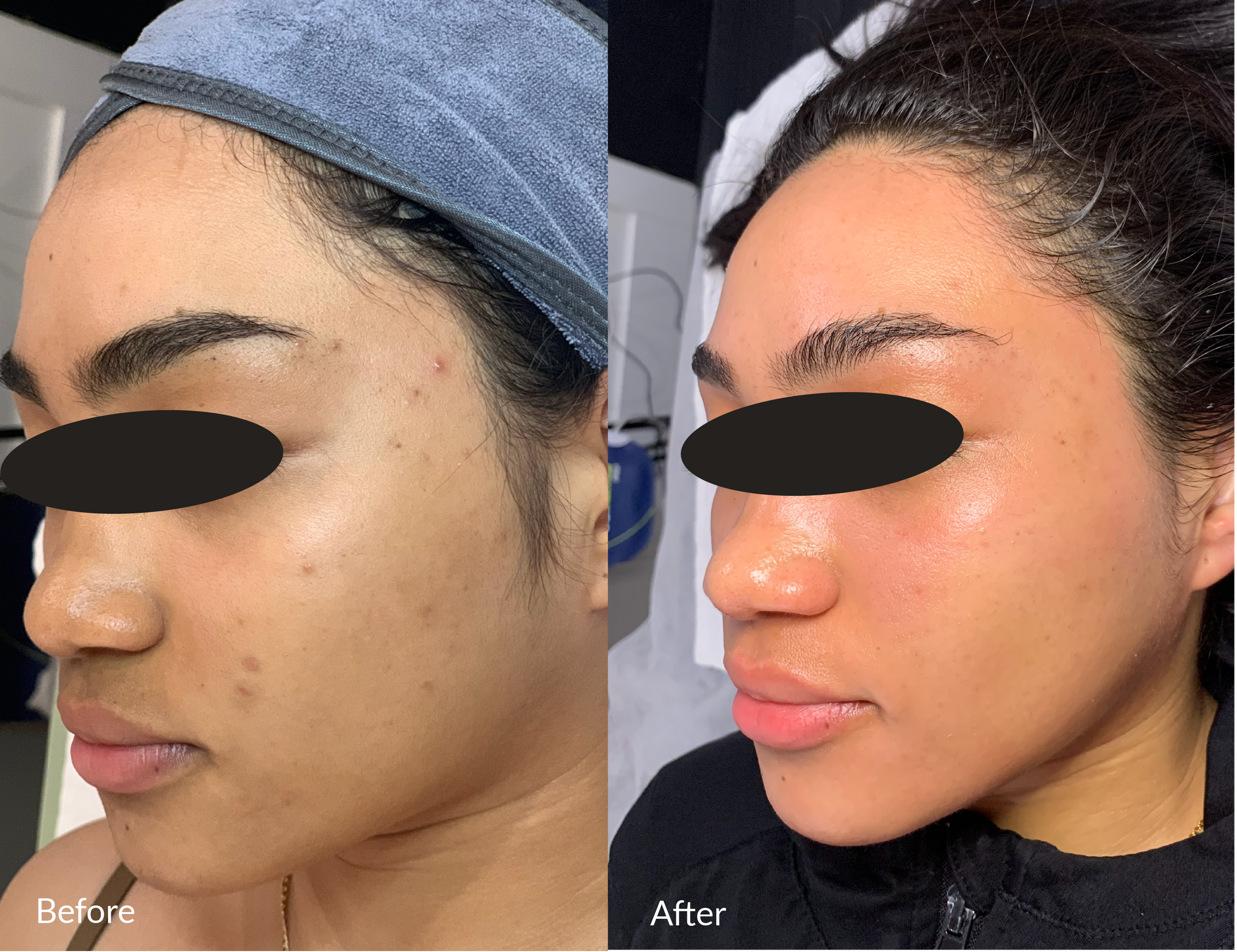 Side-by-side comparison of a woman's face before and after skincare treatment showing improved skin texture, reduced blemishes, and enhanced glow.