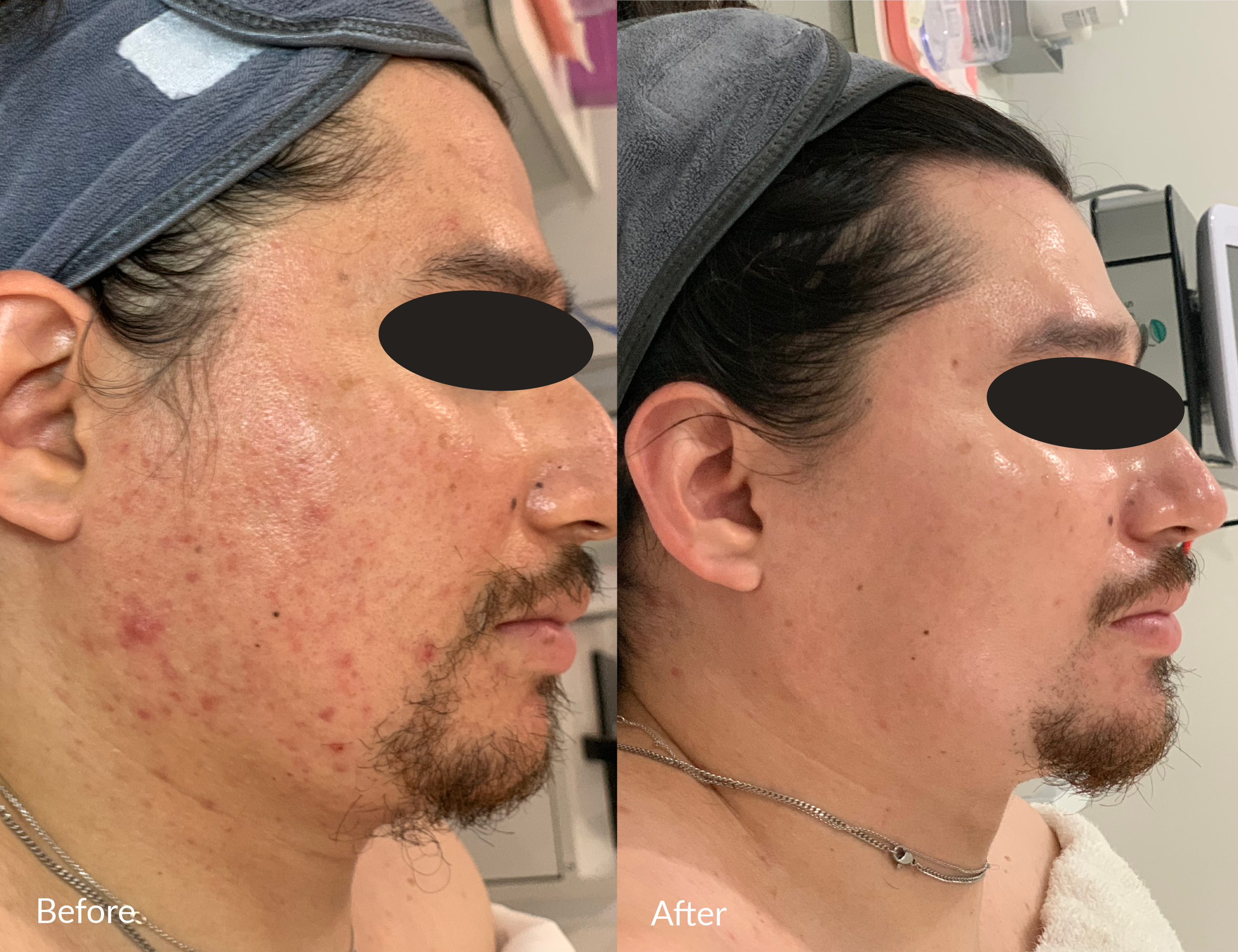 Side-by-side comparison of a man's face showing improvements in skin acne and blemishes after treatment. The left side is labeled 'Before' and shows visible acne scars and red spots. The right side is labeled 'After' and displays clearer, smoother skin with reduced blemishes.