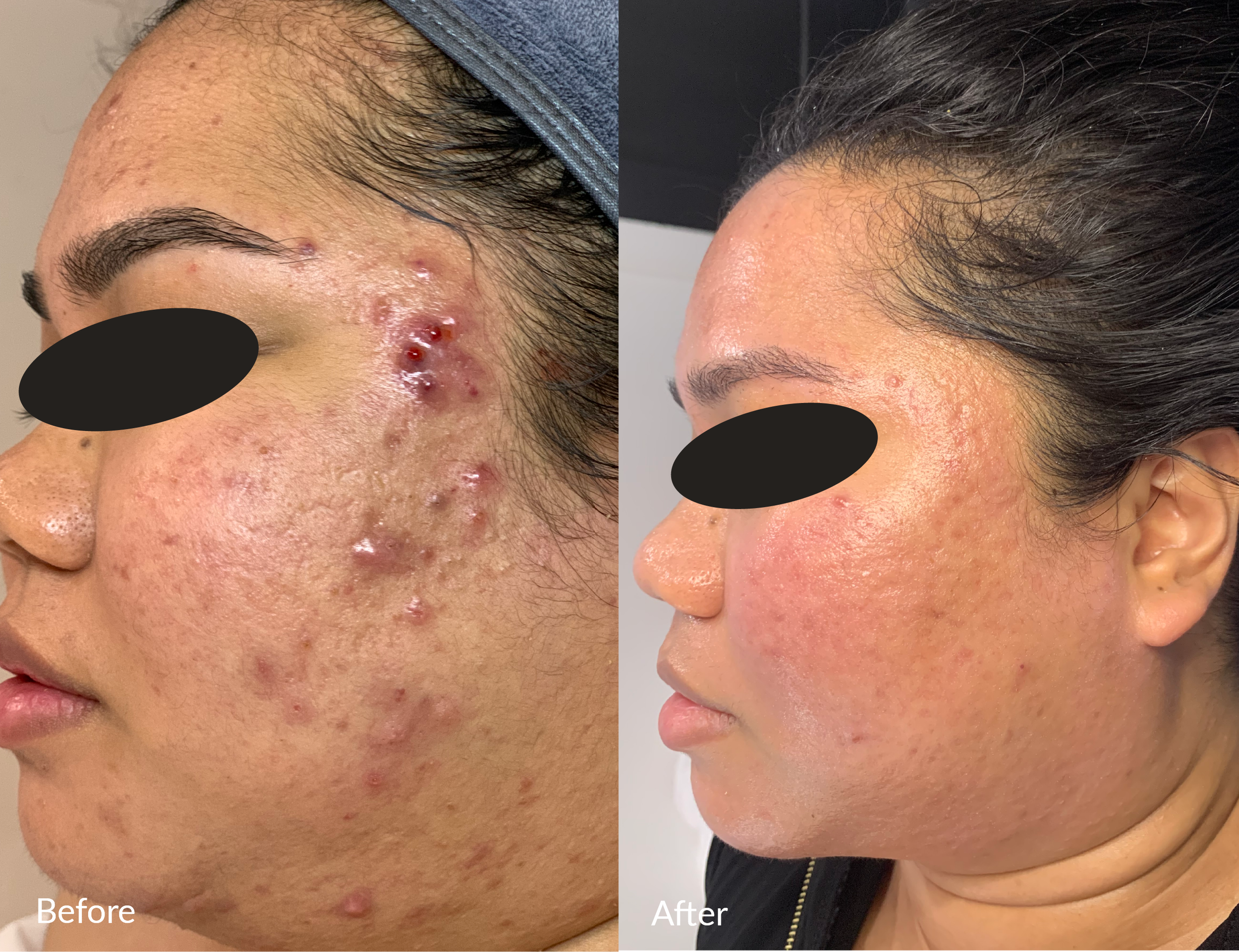 Side-by-side comparison of a woman's face showing improvement in skin condition; the left side labeled 'Before' has acne, pimples, and redness, while the right side labeled 'After' shows clear, smooth skin with fewer blemishes.