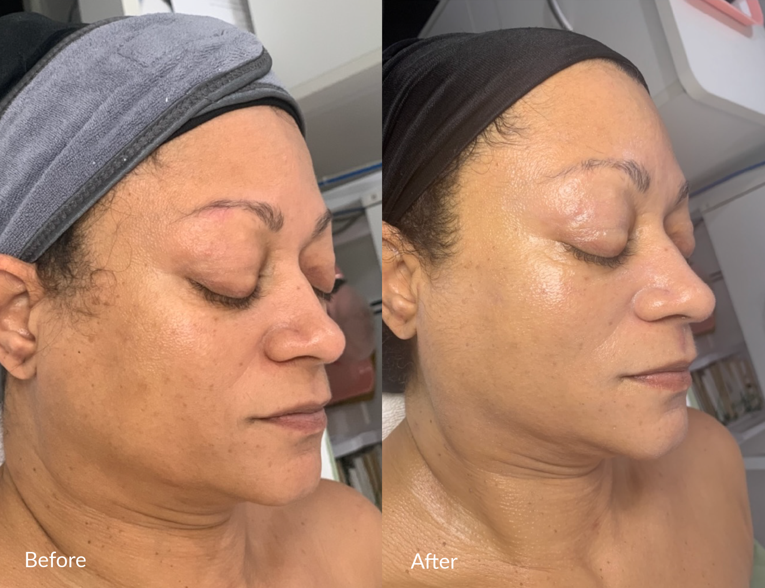 Comparison of a woman's face before and after a skincare treatment, showing improved skin texture and appearance.