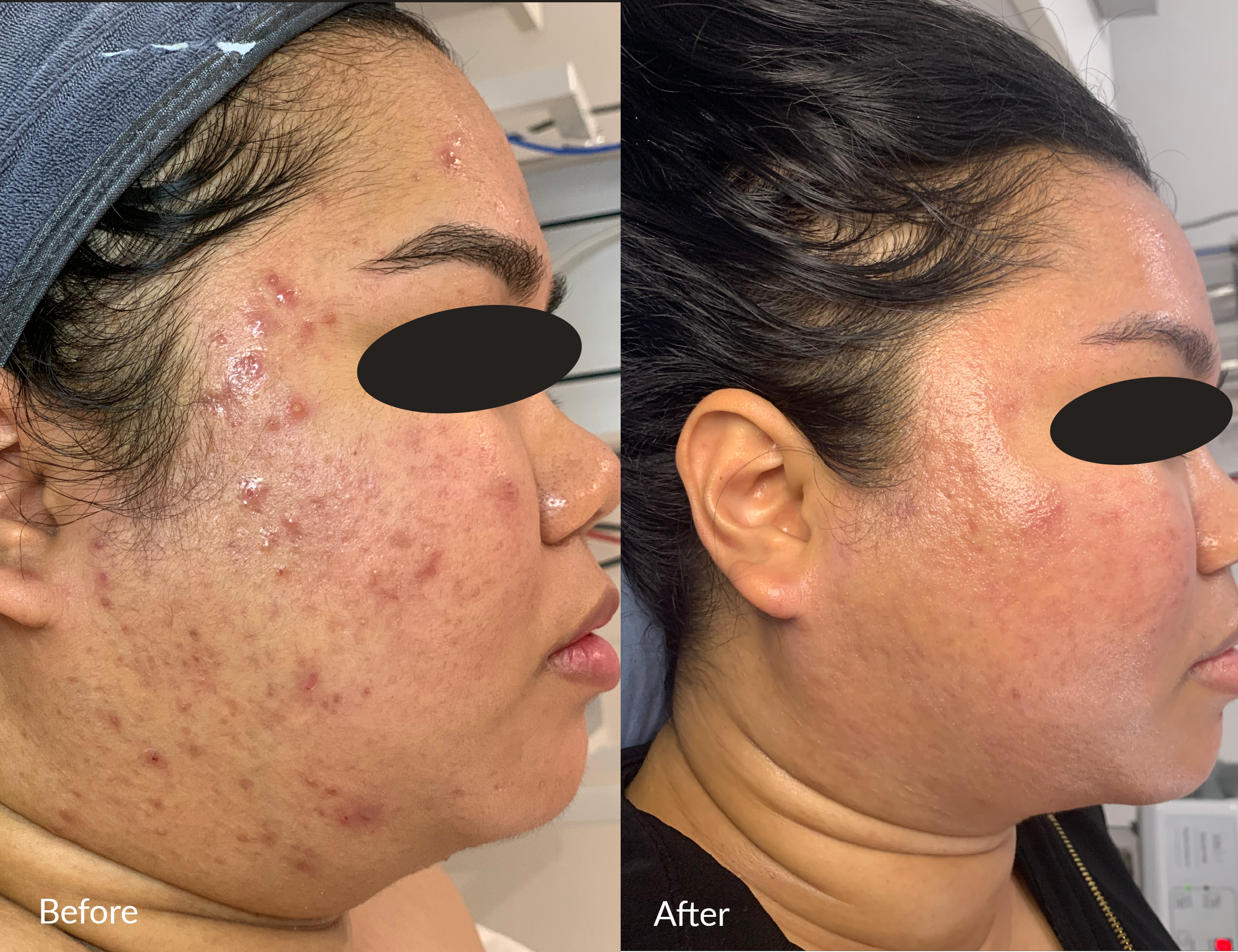 Comparison of a woman's face showing skin improvement. The 'Before' side has acne and redness, while the 'After' side shows clearer skin with reduced acne and redness.