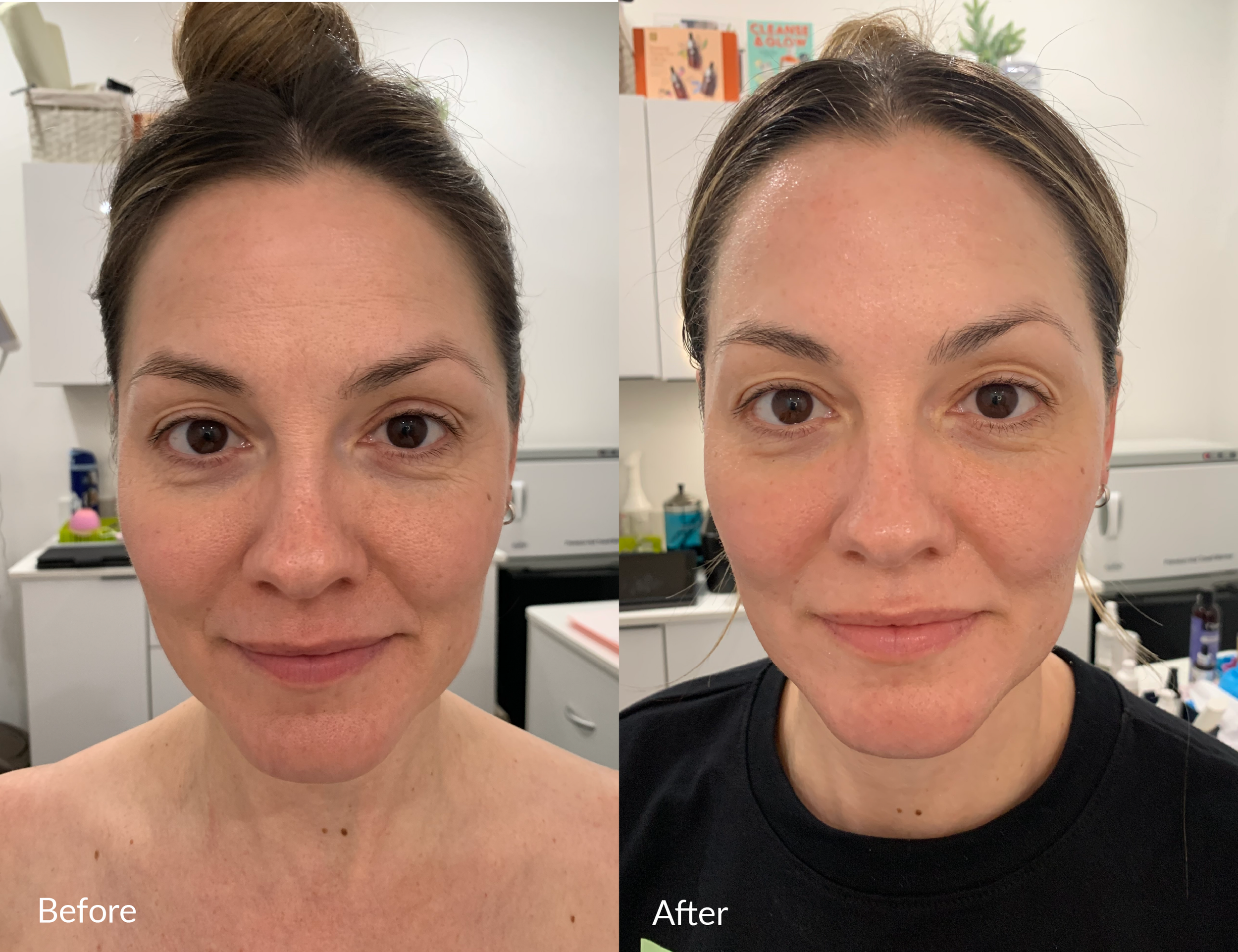 Comparison of a woman's face before and after skincare treatment, showing clearer skin and a reduction in blemishes in the after image. The woman has light skin and dark hair, with a background of a white room with medical or skincare products.