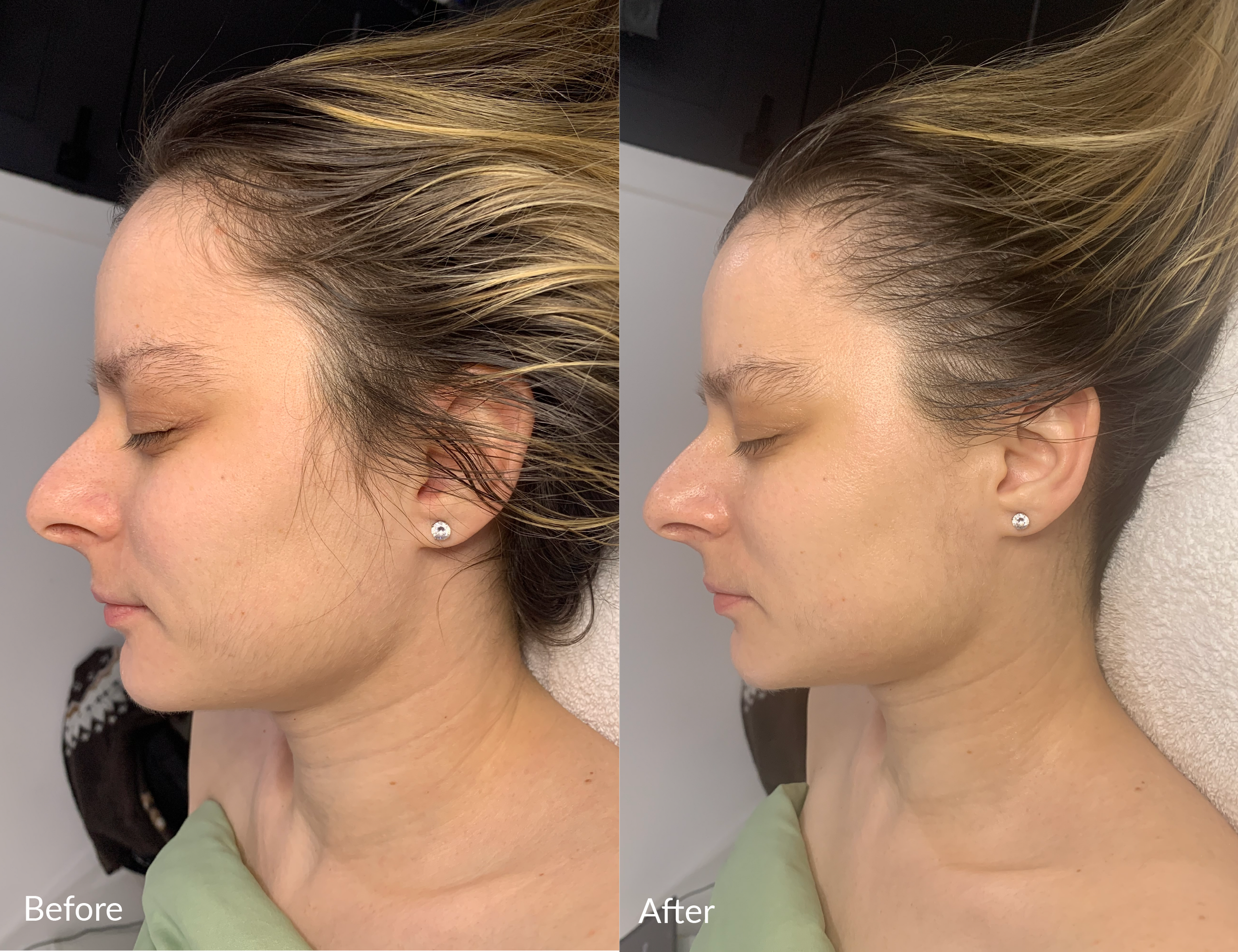 Side-by-side comparison of a woman's hair and scalp before and after a hair treatment, showing improved hair volume and scalp coverage in the after image.