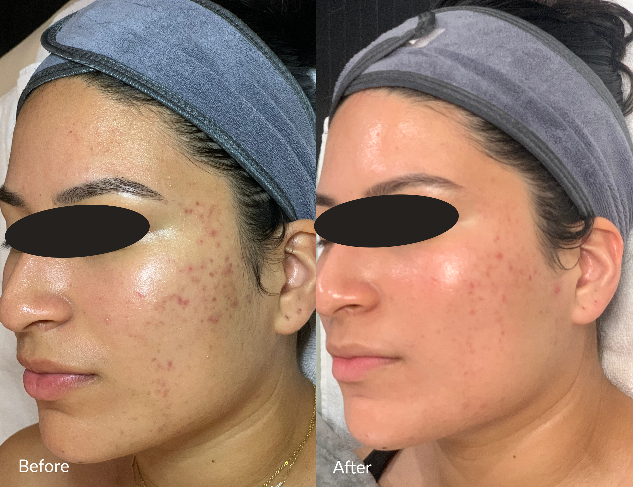 A side-by-side comparison of a woman’s face before and after skincare treatment; the left side shows acne and redness, while the right side shows clearer, smooth skin.