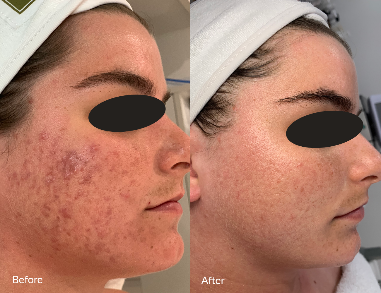 Comparison of a woman's face before and after skincare treatment. The before side shows red, inflamed, and acne-prone skin, while the after side shows clear, smooth skin with reduced redness.