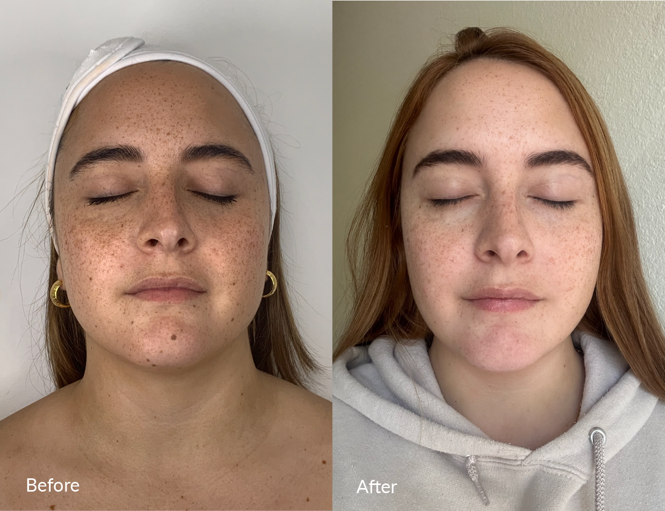 Side-by-side comparison of a woman before and after skin treatment, showing reduced freckles and clearer skin, with closed eyes and neutral expression.