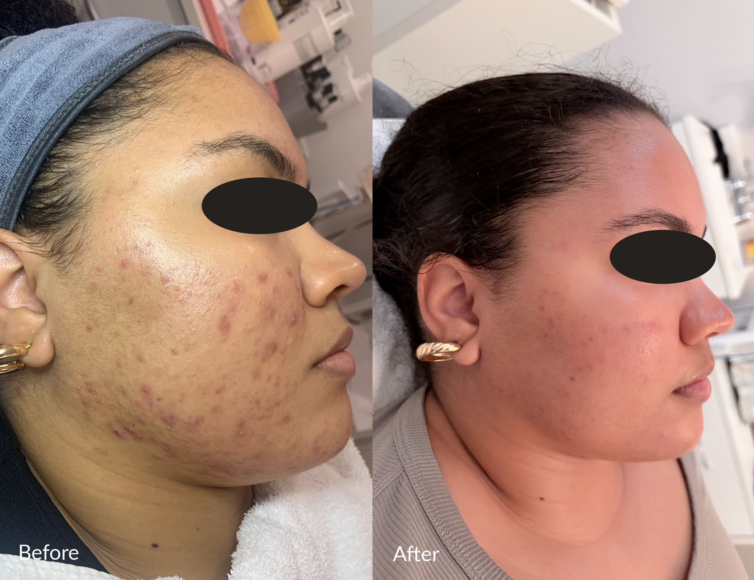 Side-by-side comparison of a woman before and after skin treatment showing improvement in acne and skin clarity.