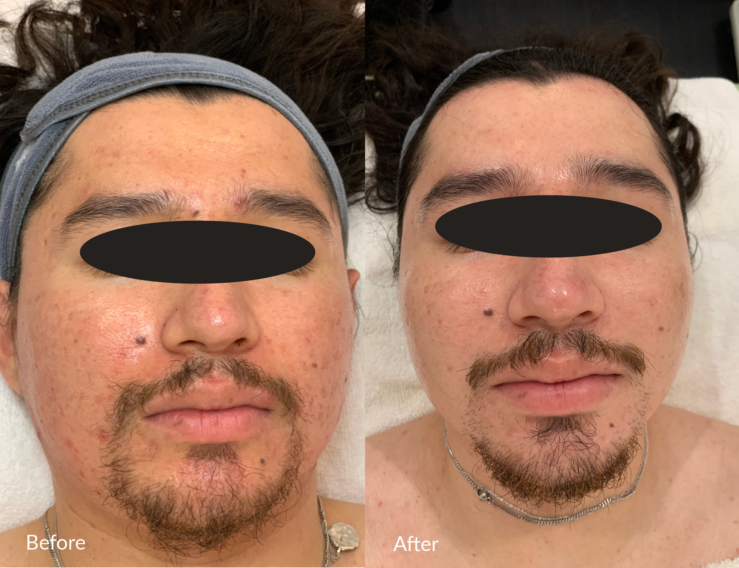 Side-by-side comparison of a man before and after a skincare or dermatological treatment, showing improvements in skin clarity and texture, with visible reduction of acne or blemishes.