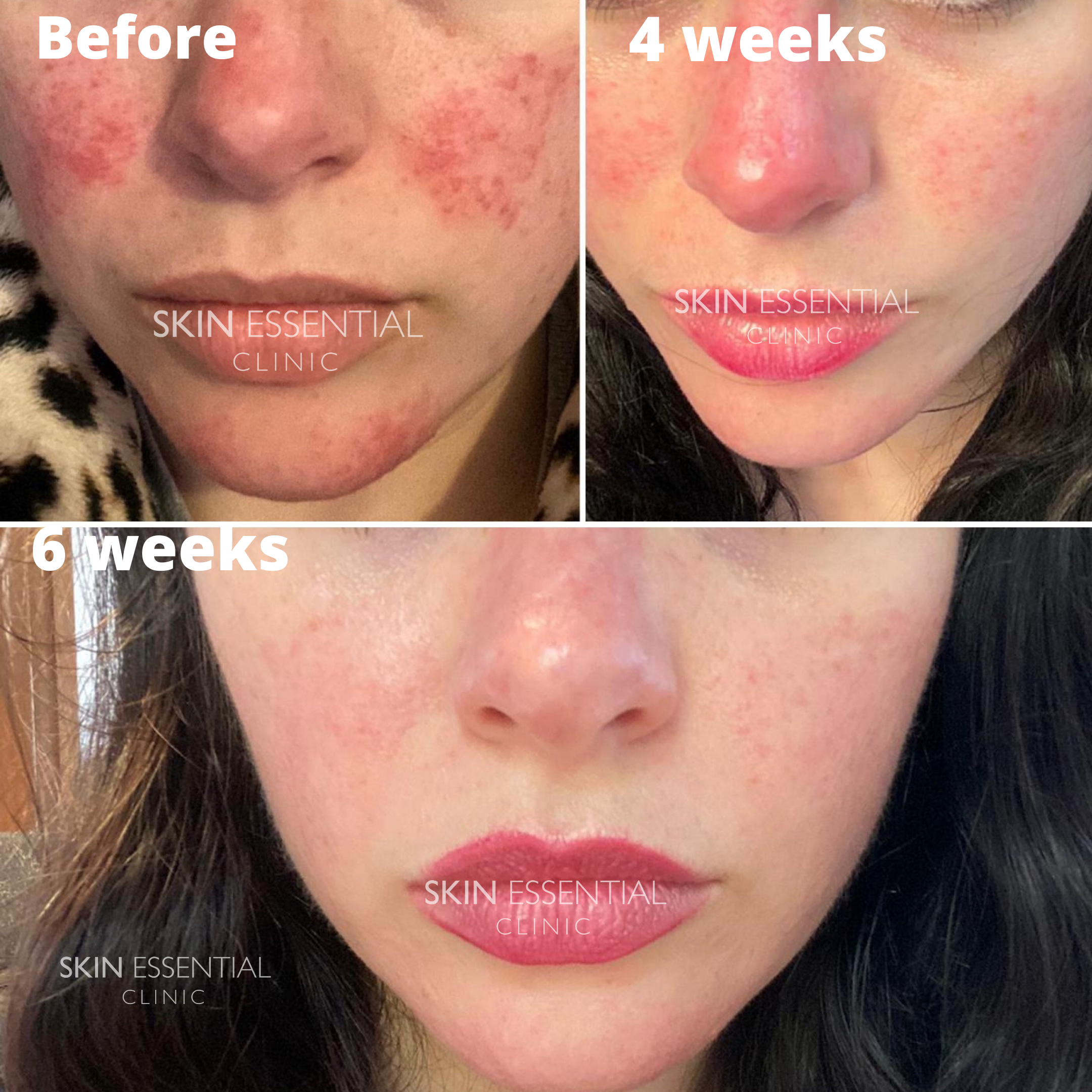 Progress photos showing the reduction of facial redness over six weeks at SKIN ESSENTIAL CLINIC, with images labeled 'Before,' '4 weeks,' and '6 weeks.'