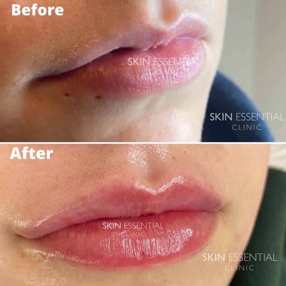 Close-up of a person's lips showing a before and after comparison. The before image shows dry, chapped lips, while the after image shows smooth, moisturized, and glossy lips.