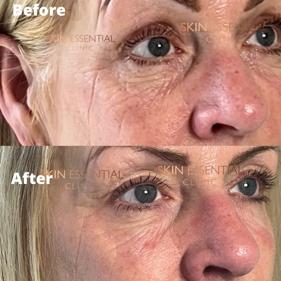Close-up of a woman's eye area before and after skincare treatment, showing reduced wrinkles and smoother skin.