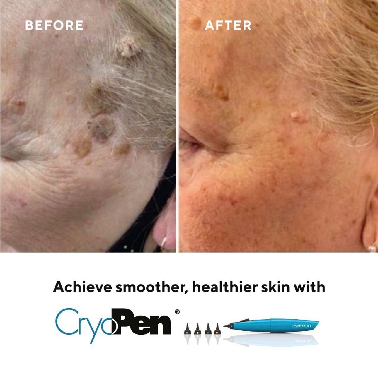 Comparison of a person's skin before and after using CryoPen, showing improved skin smoothness and health.