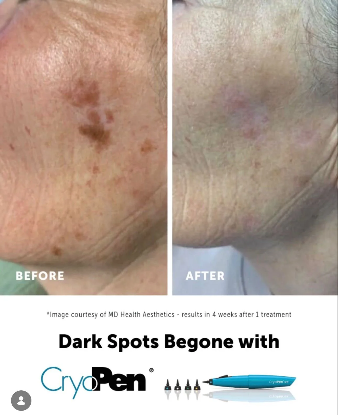 Side-by-side comparison of a chin with dark spots before and after treatment, showing improvement in skin pigmentation with CryoPen.