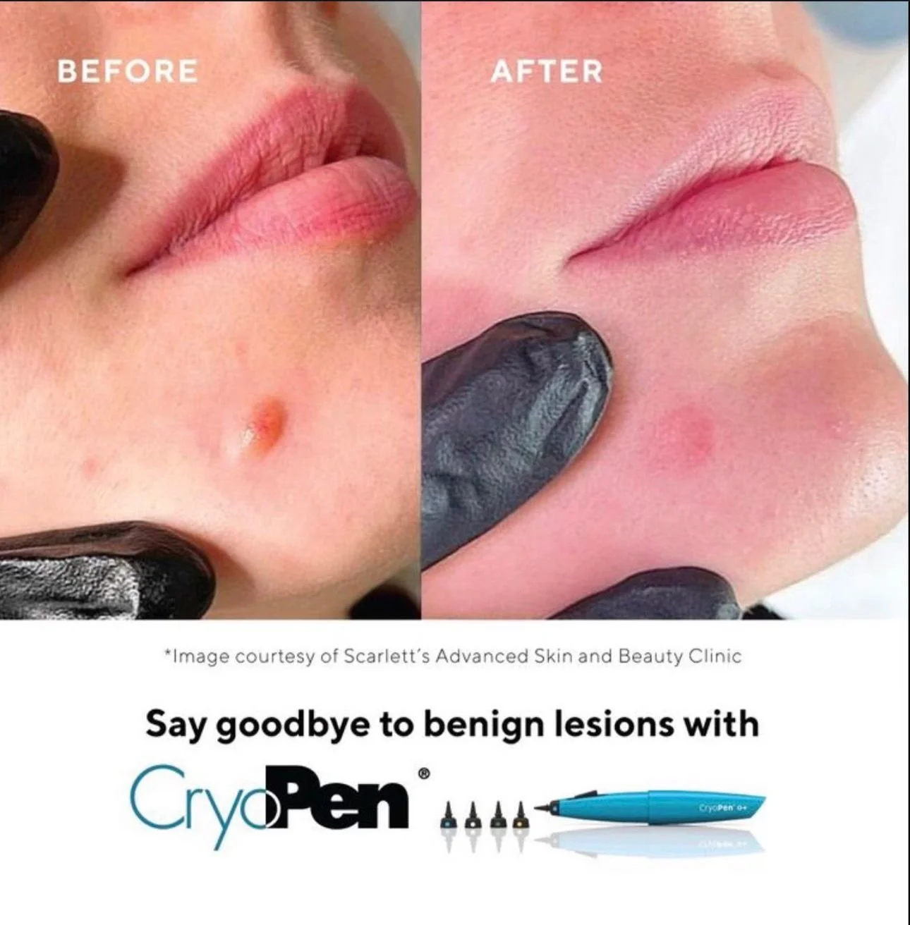 Before and after images showing the removal of skin lesions on the face using CryoPen, a cryotherapy device, with the after image showing reduced or healed skin lesions.