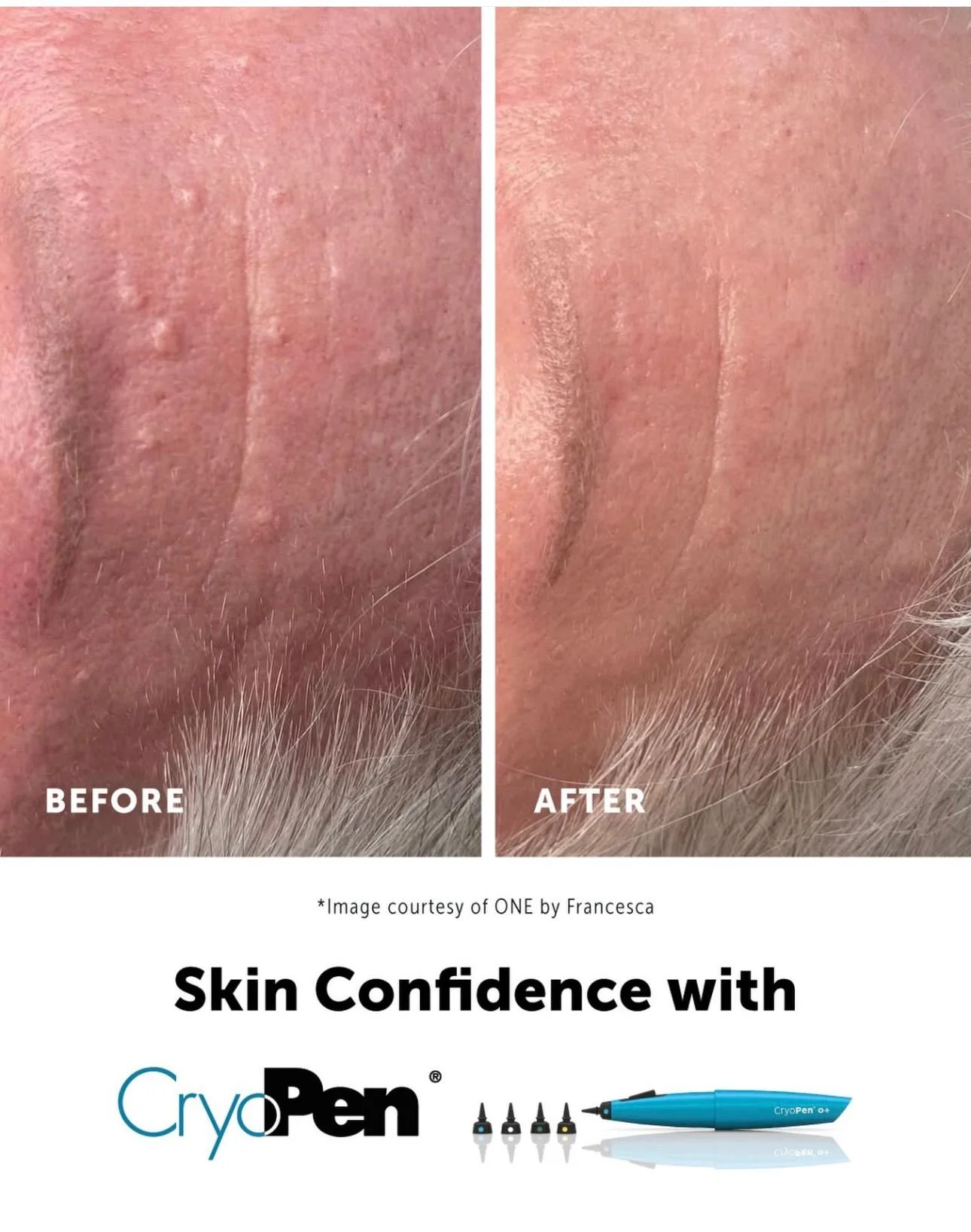 Before and after comparison of skin treatment showing improved skin texture and reduced blemishes after using CryoPen.