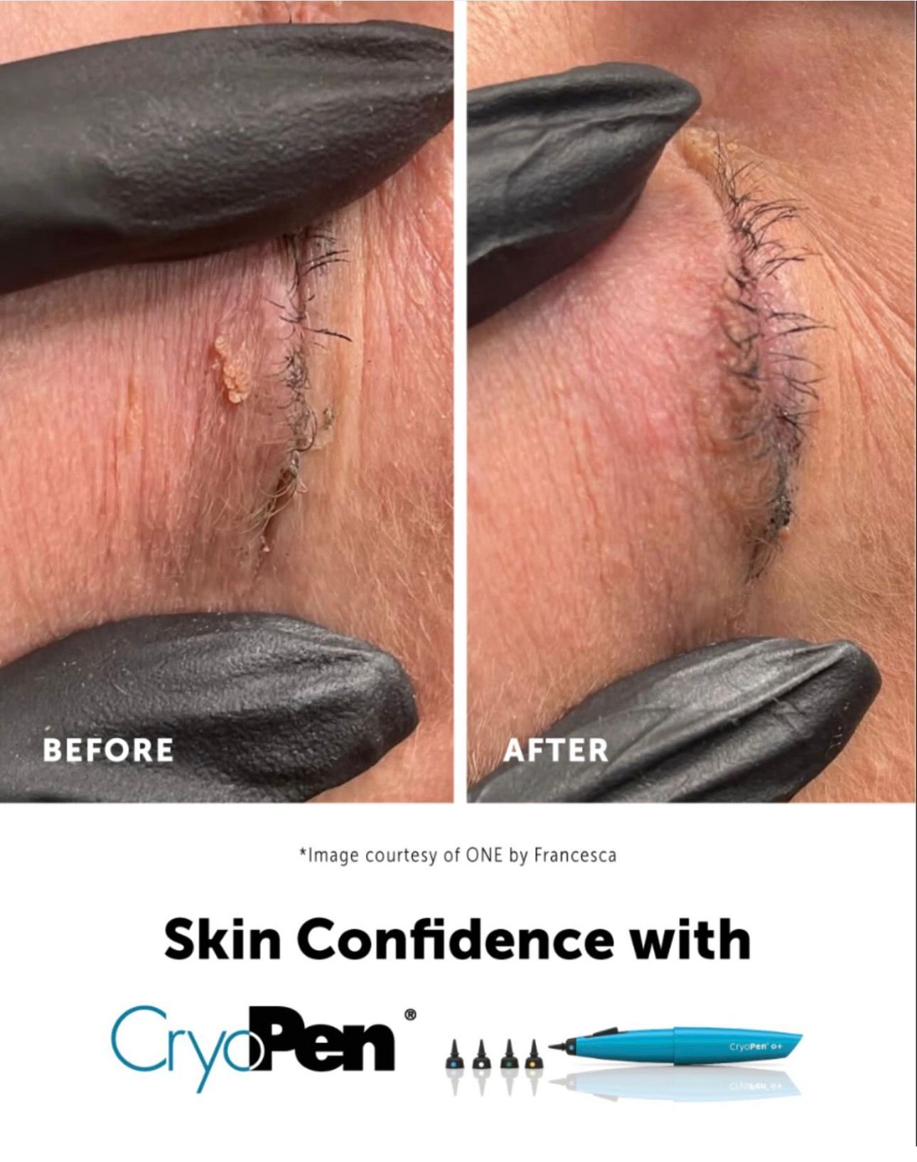 Before and after images showing the removal of skin tags around the eye using CryoPen, a freezing treatment. The before image has skin tags present, and the after image shows clear skin after treatment.