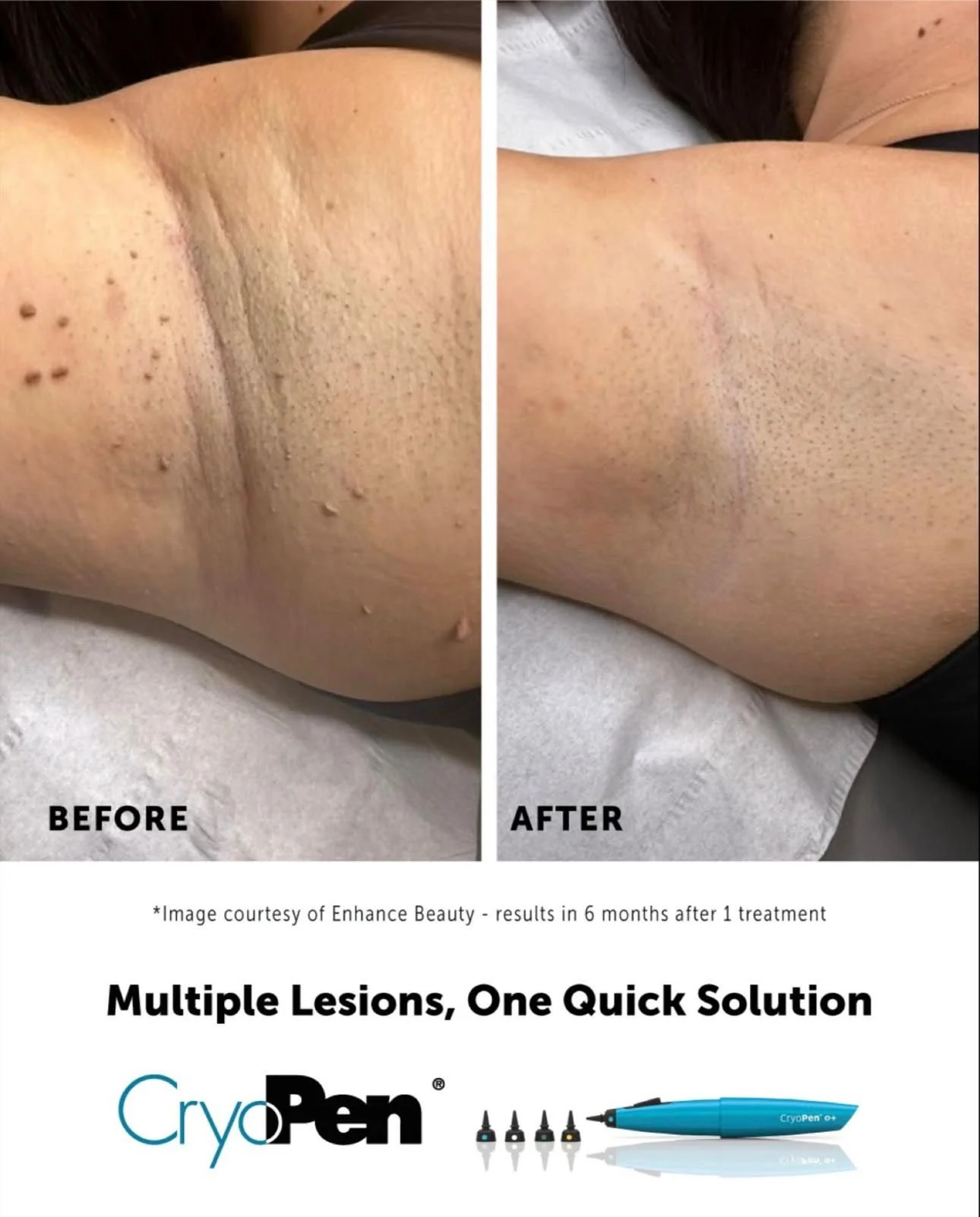 Side-by-side comparison of a person's back before and after a treatment, showing reduction in multiple skin lesions and improved skin appearance.