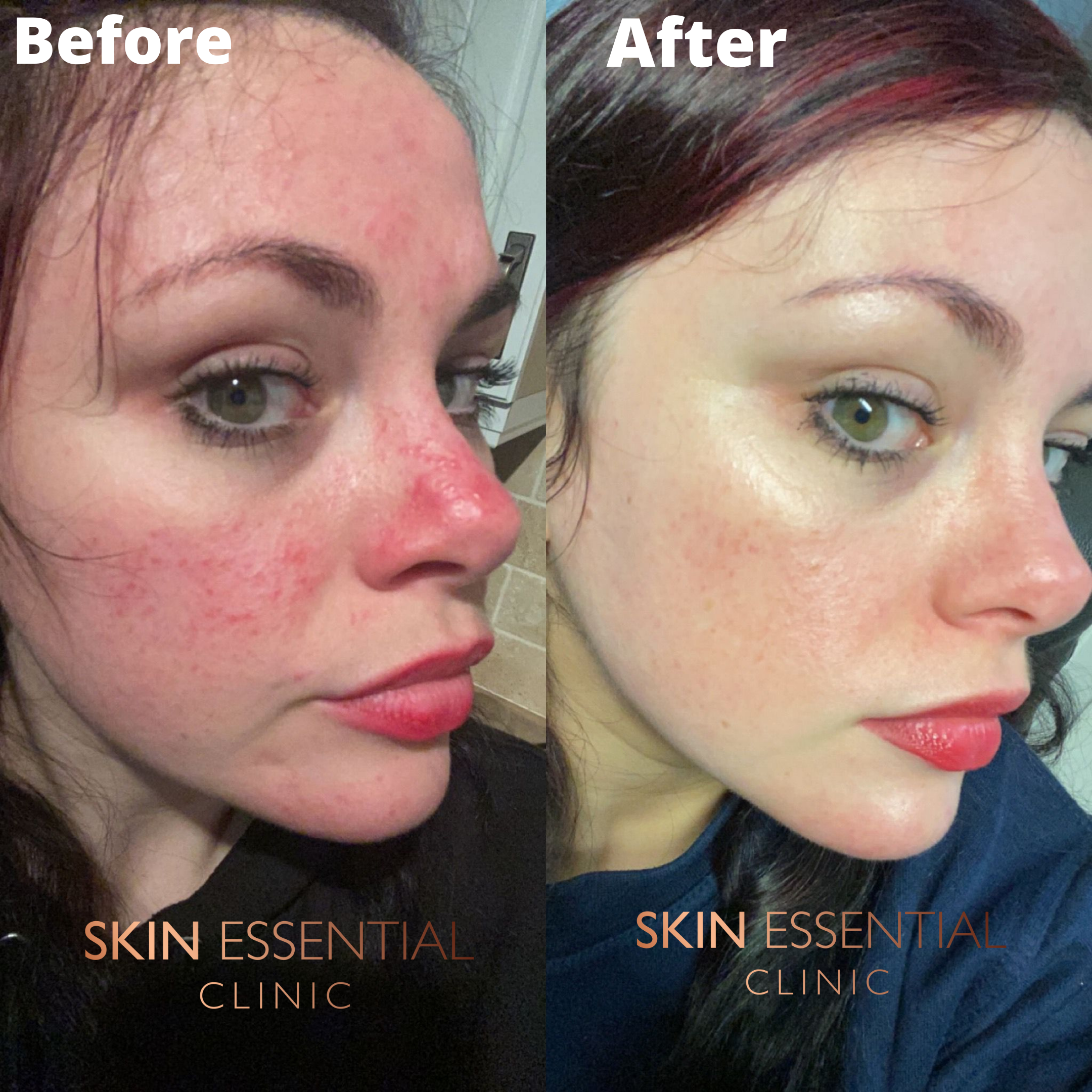 Side-by-side comparison of a woman before and after skin treatment. The before image shows red, inflamed skin with acne scars, while the after image shows clear, smooth skin with minimal redness.